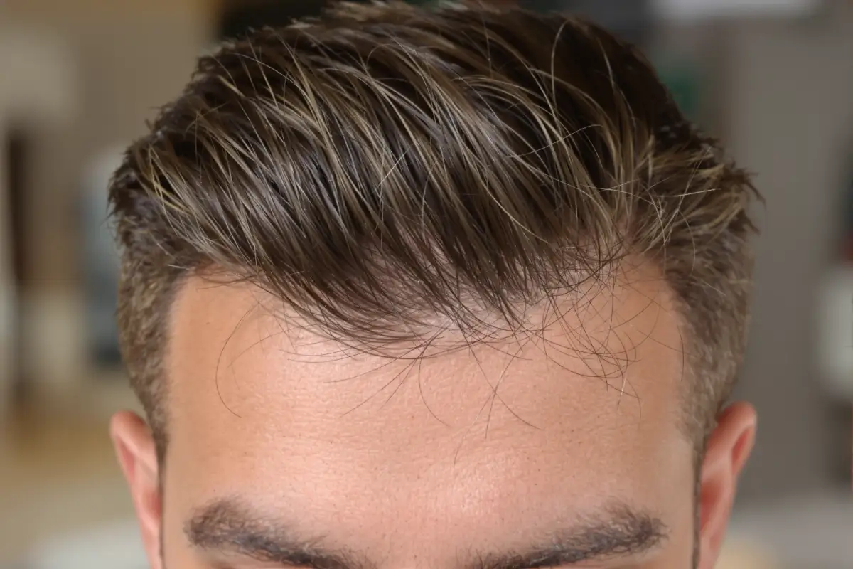 Hair Transplant Costs: Turkey vs Germany Explained