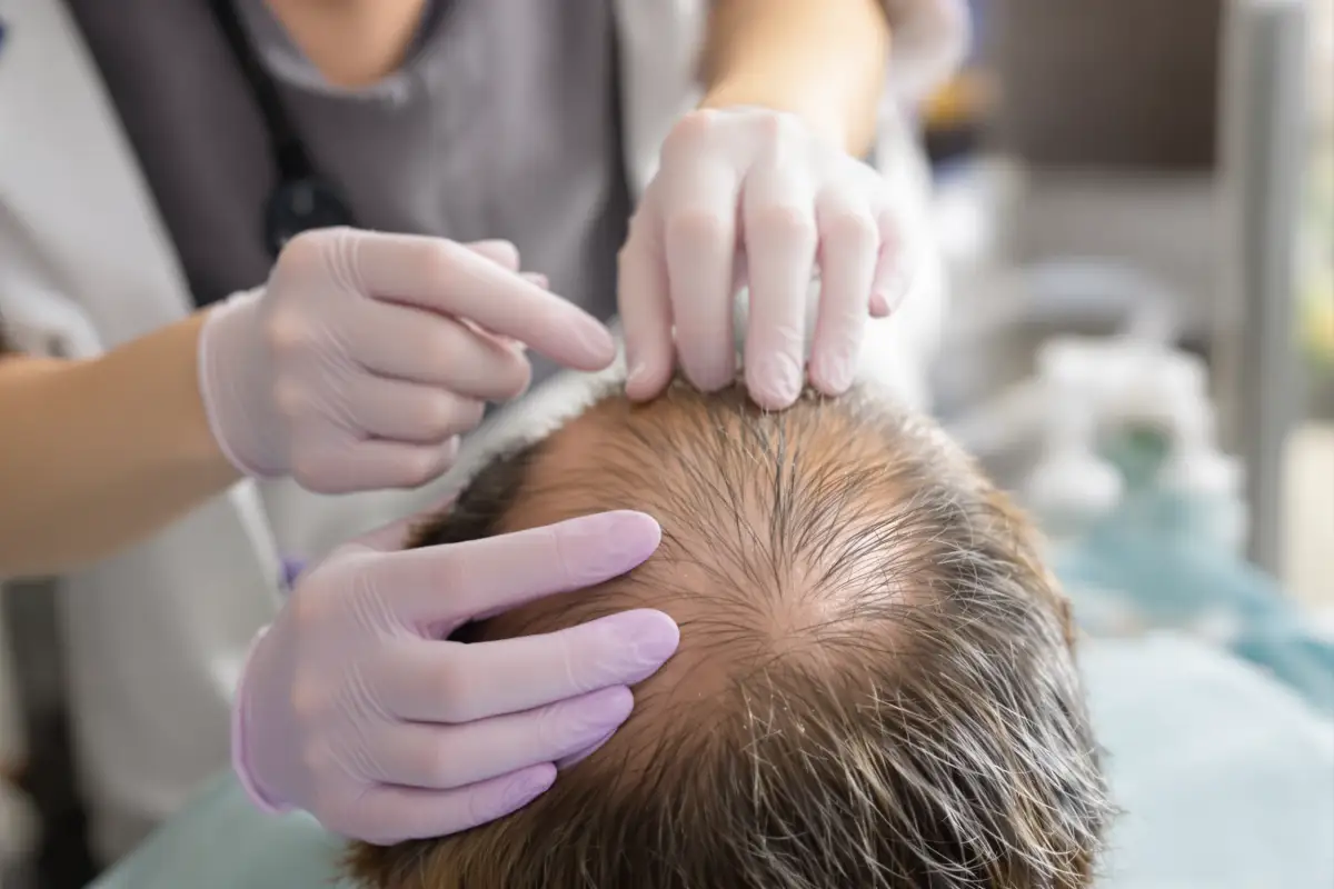 Admissibilité à la greffe de cheveux en Turquie