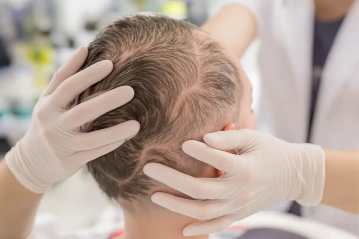 How to Take Care of Your Scalp After a Hair Transplant