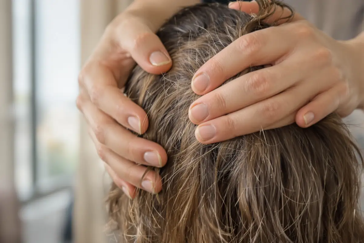 Understanding Scalp Yeast Infections and Treatments