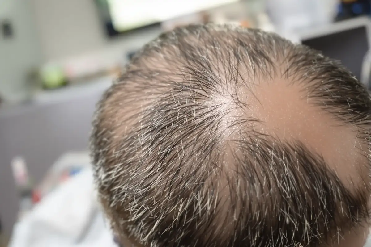 شرح زراعة الشعر بالخلايا الجذعية مقابل العلاجات
