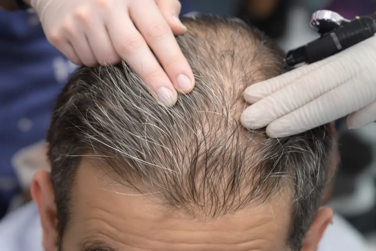 ما يمكن توقعه من نتائج زراعة الشعر