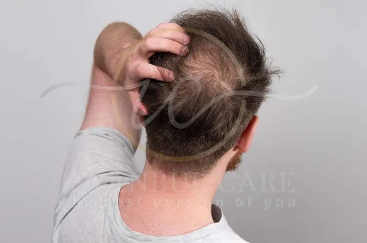 Un hombre no identificado fotografiado desde atrás levantándose el pelo con una mano para exponer la pérdida de densidad en la coronilla.