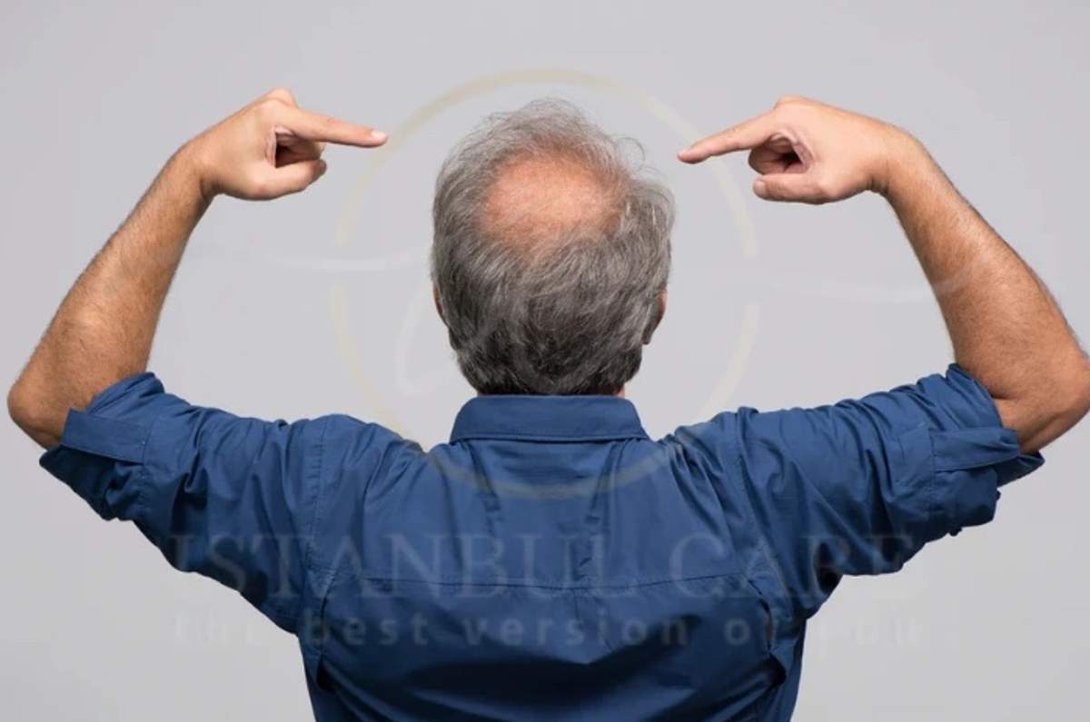 An unidentified man photographed from behind against a plain background, pointing both index fingers at the bald area on top of his own head.
