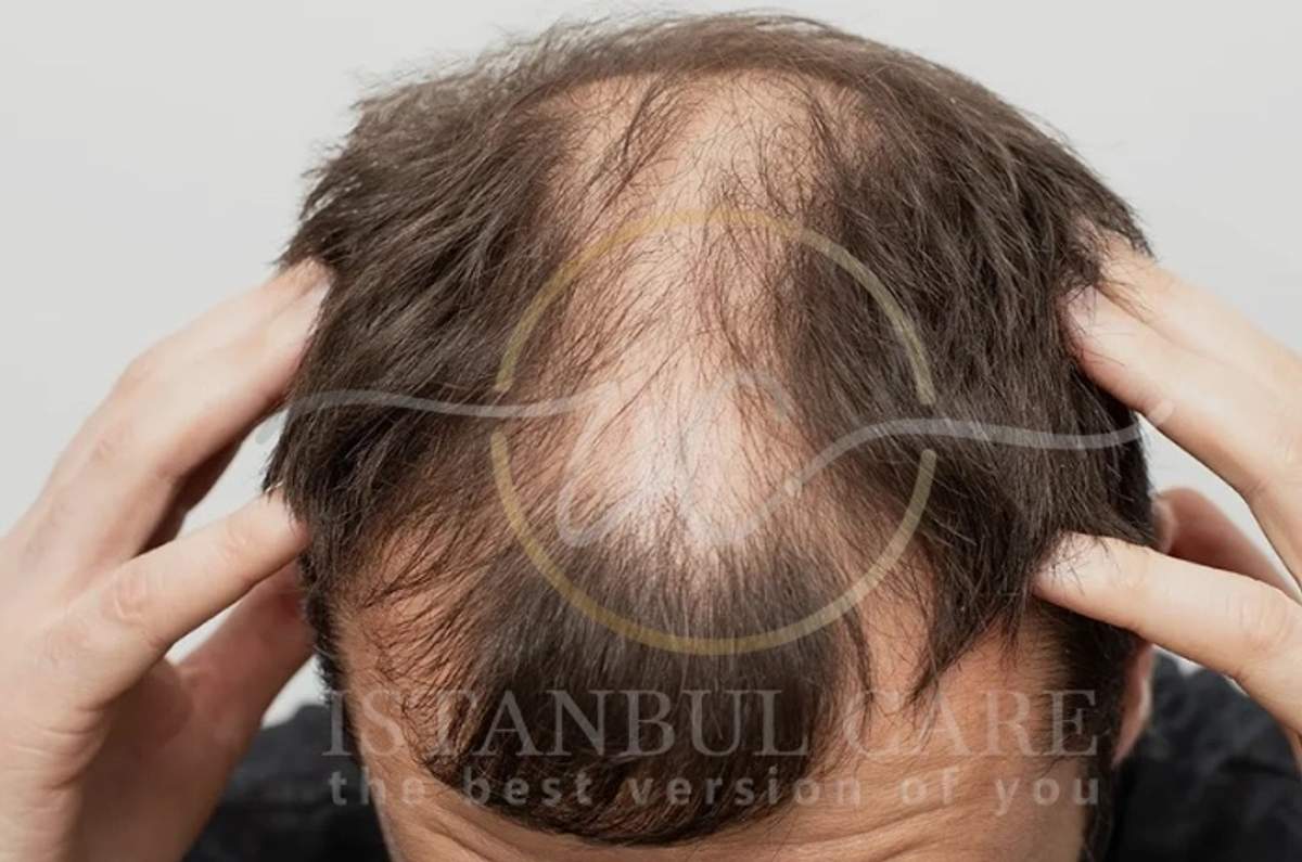 Vista desde arriba del cuero cabelludo de un hombre no identificado con el cabello separado con ambas manos, mostrando un área circular adelgazada en la coronilla.