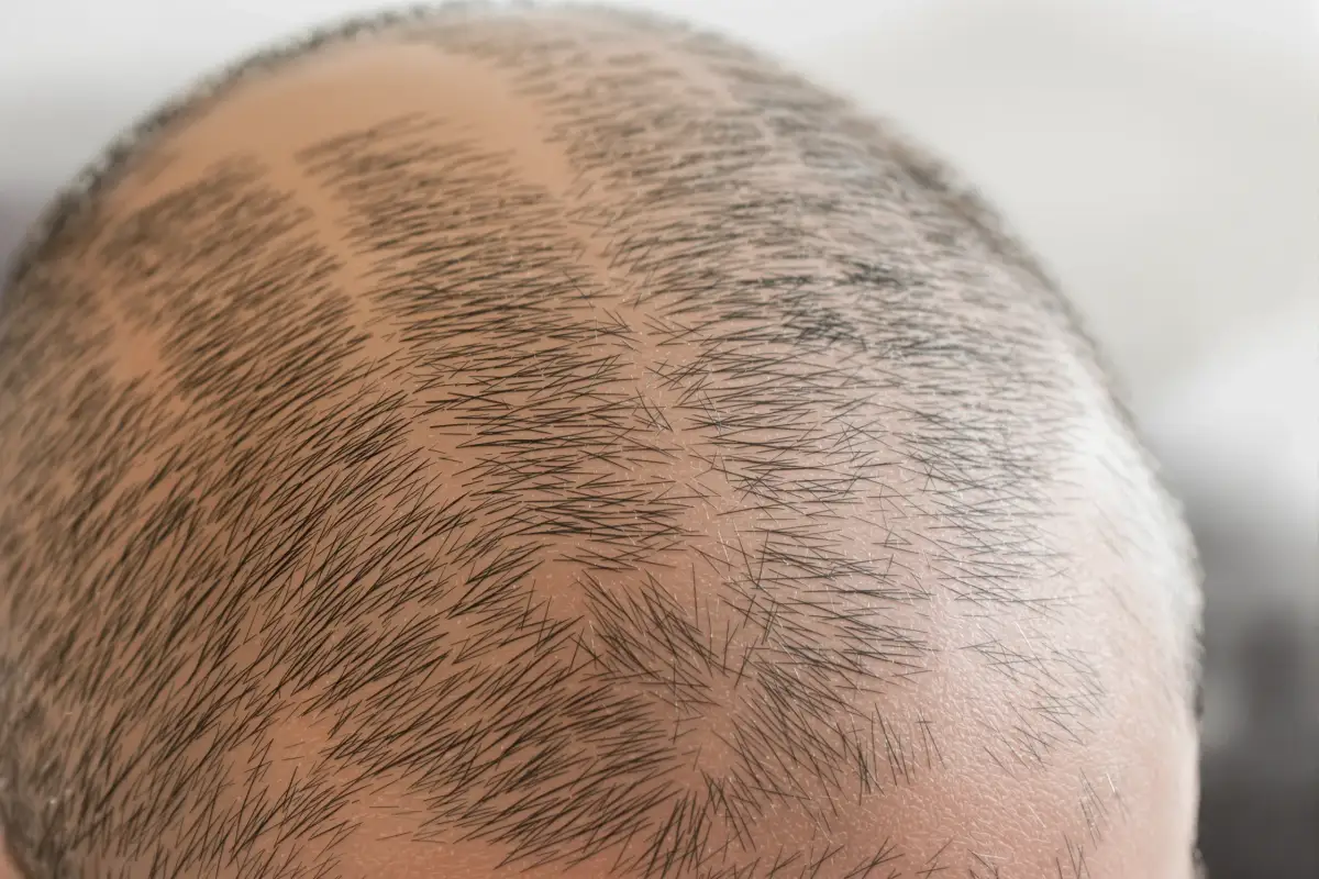 Bald Hair Solu srcset=