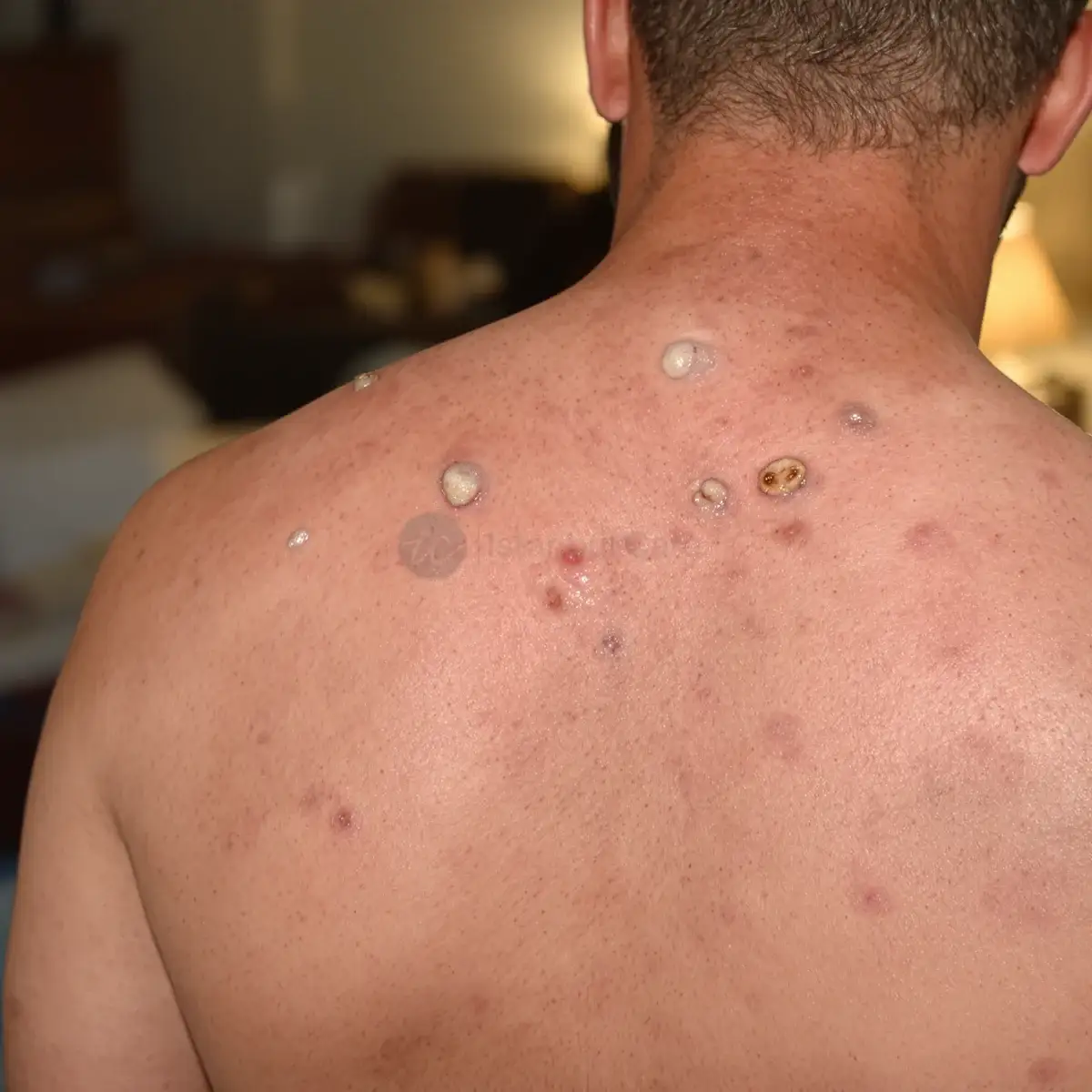 Pustules and inflamed nodules of deep folliculitis across a man's upper back, shown for visual identification of infected hair follicles – Istanbul Care