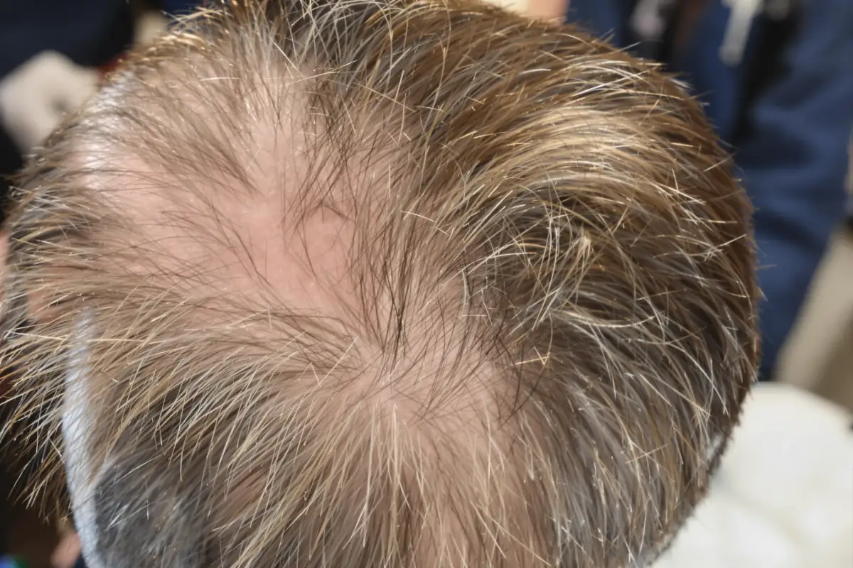 Greffe de Cheveux FUE en Turquie : Coût, Procédure et Résultats
