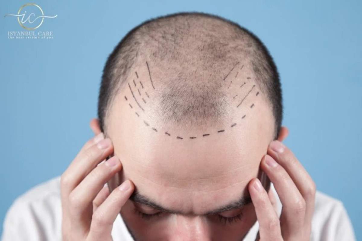 DHI hair transplant in Turkey — packages and cost