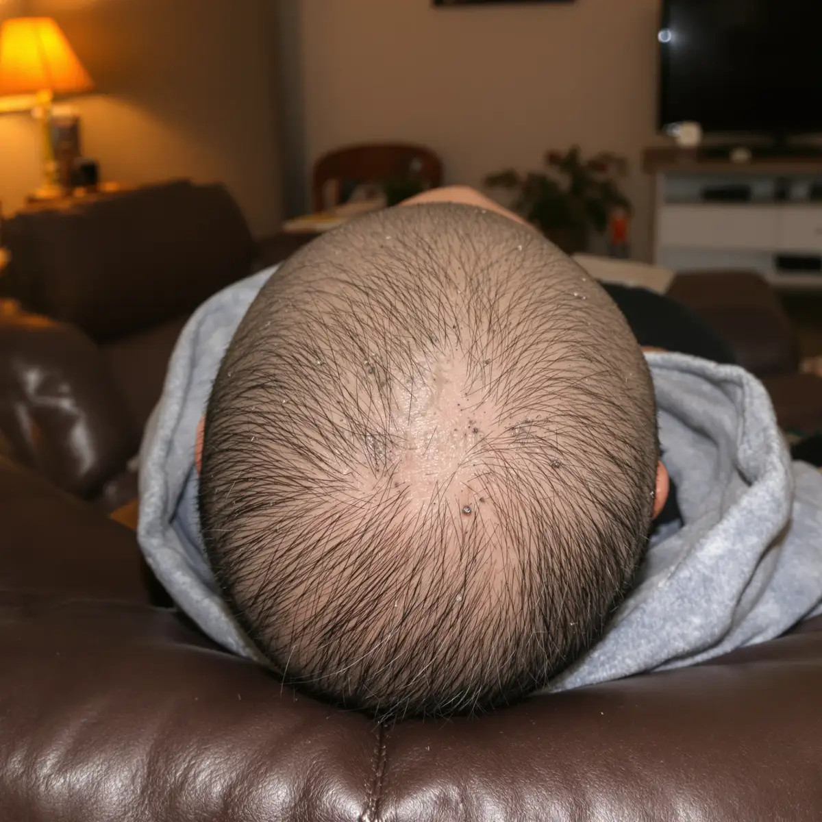 Top-down view of a scalp in the first days after a hair transplant, with small crusts around each graft