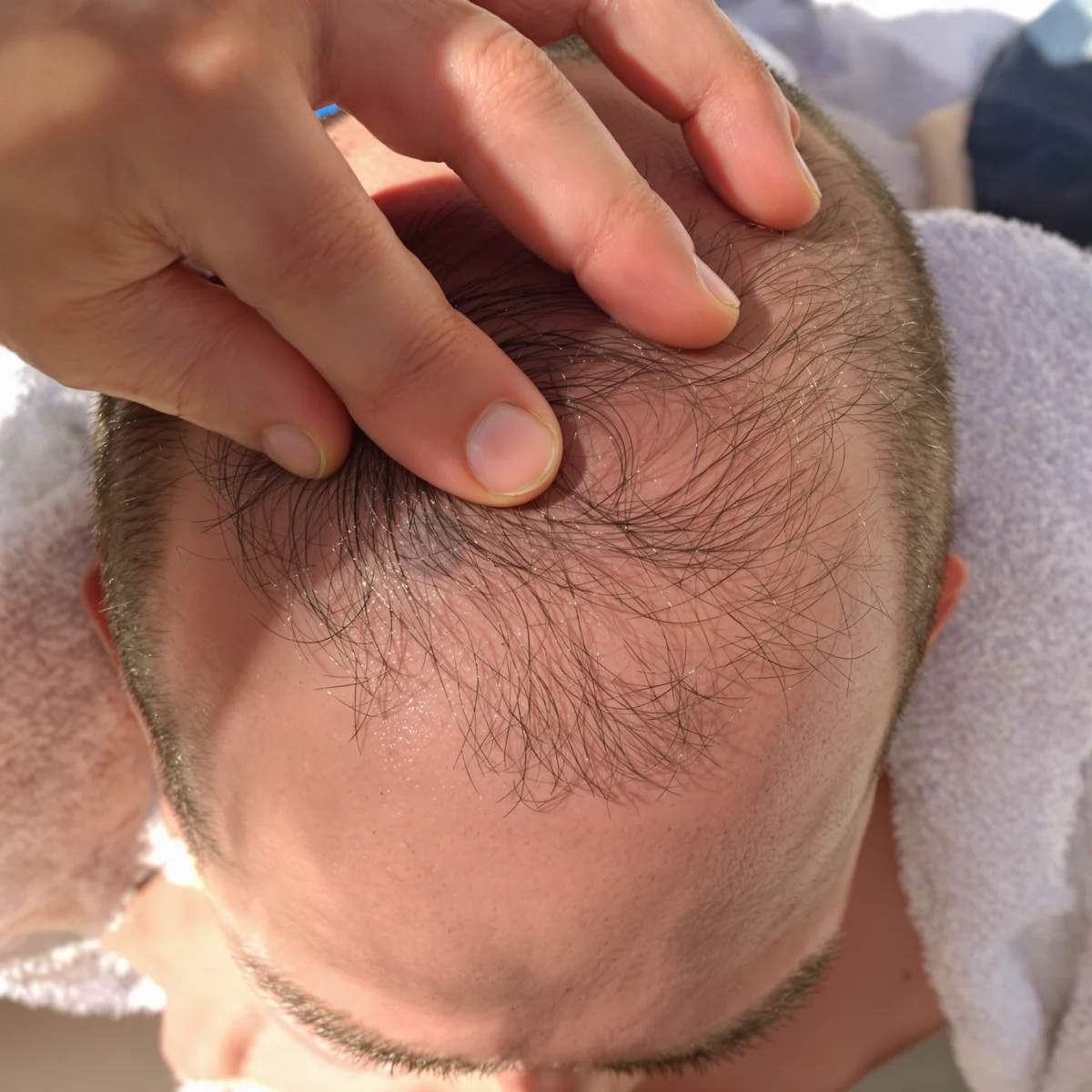 Close-up top view of a man’s frontal scalp with fingers parting sparse hair to show thinning between the temples