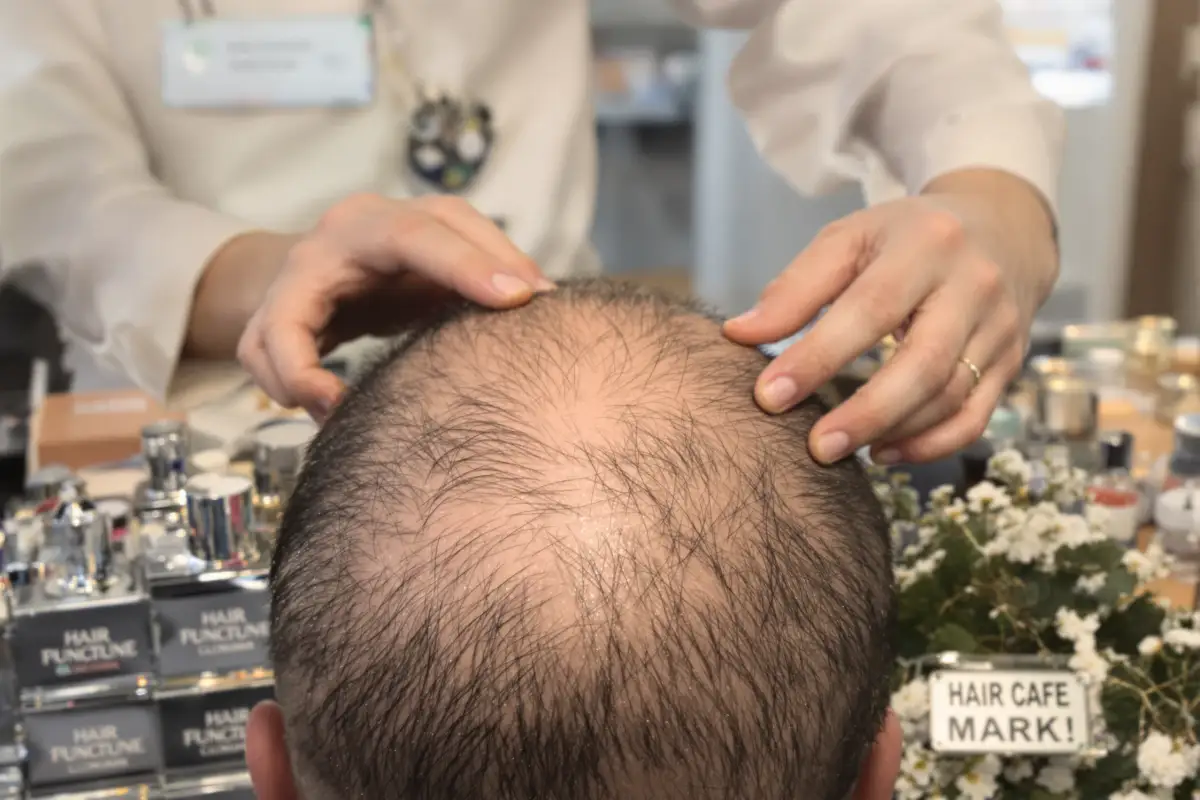 زراعة الشعر في تركيا للفروة المليئة بالندوب: ما الذي ينجح