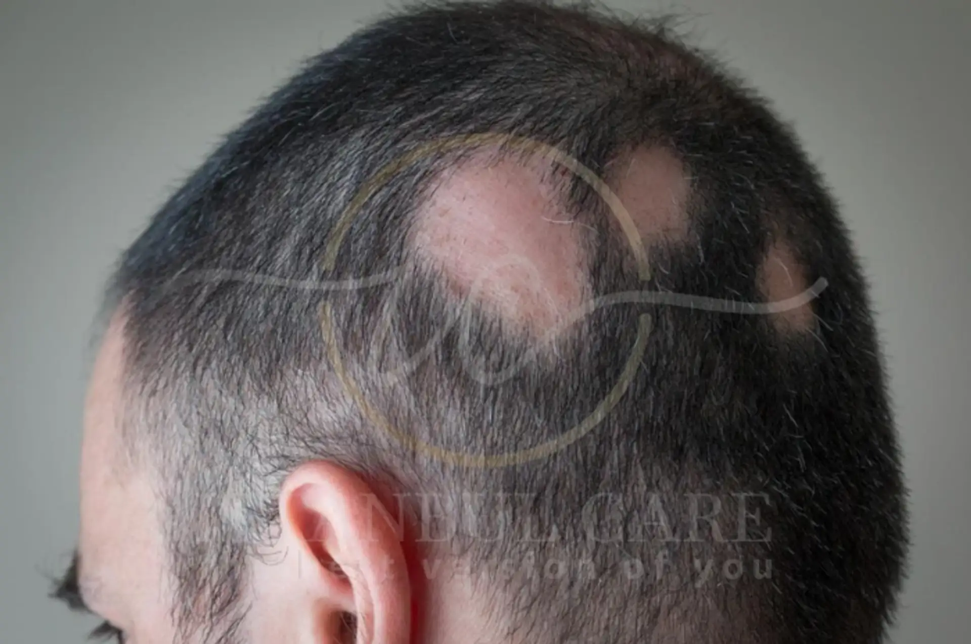 Alopecia Areata Hair Fall Symptoms Causes and Treatment