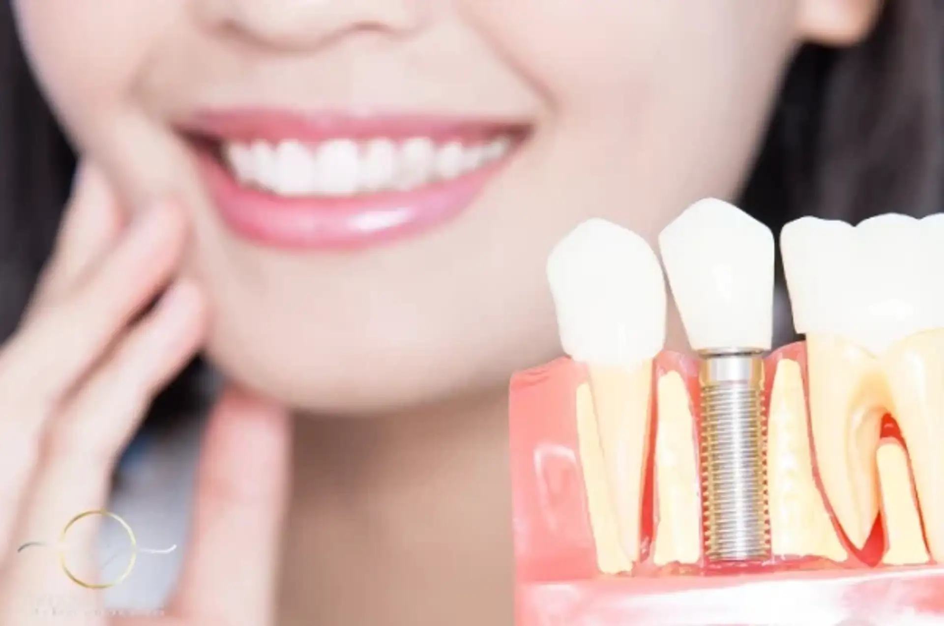 Los 5 países más baratos para implantes dentales All-on-4