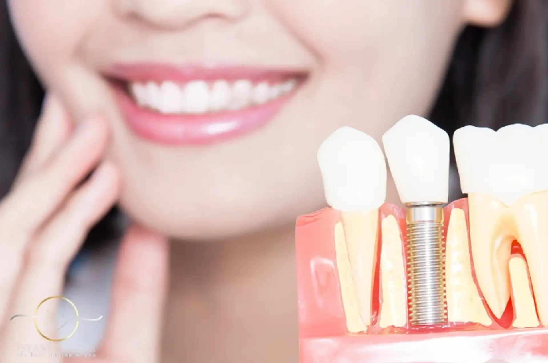 Things to Know After a Dental Implant Procedure