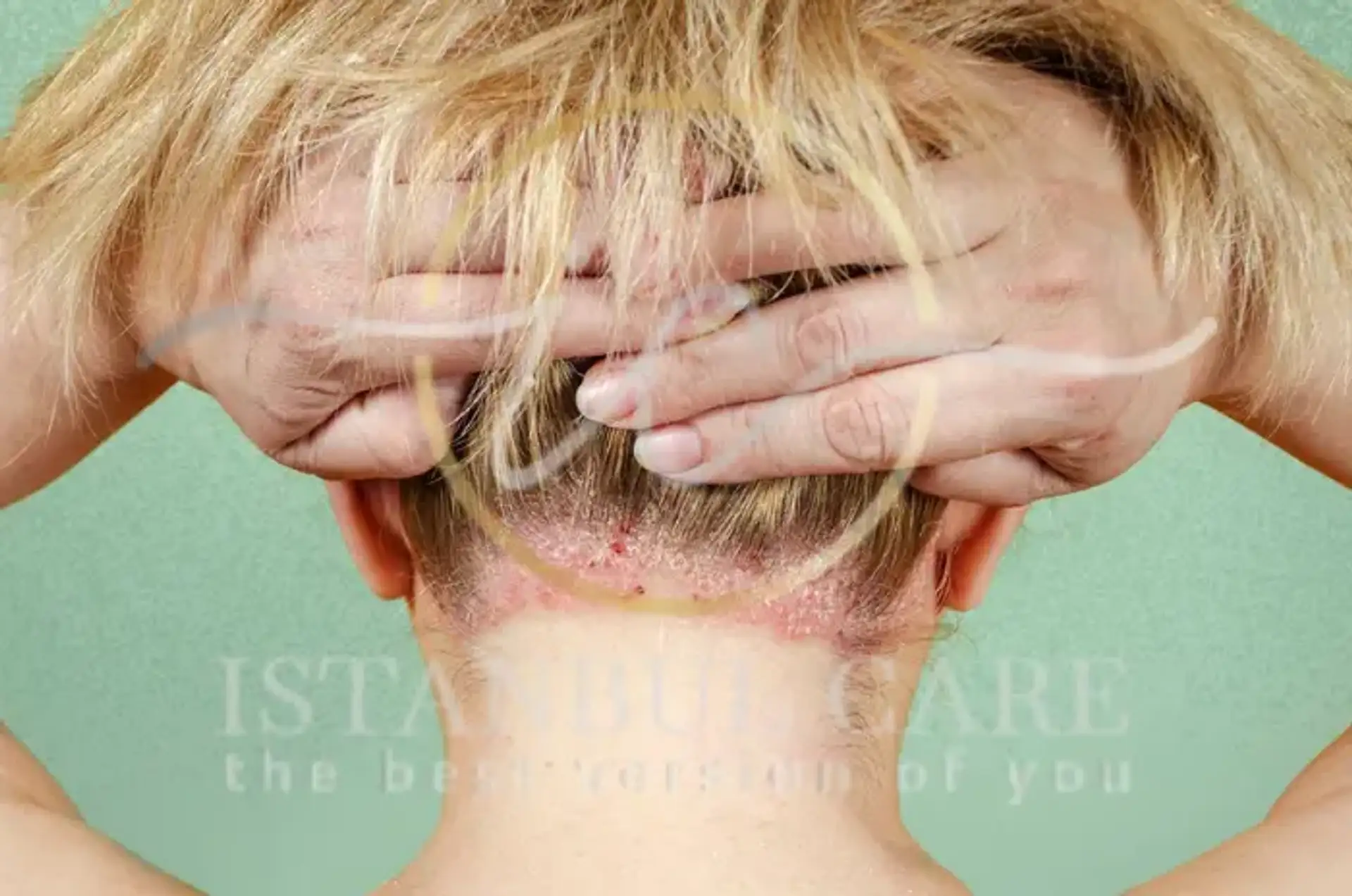 Scalp Psoriasis Treatment Options and Management