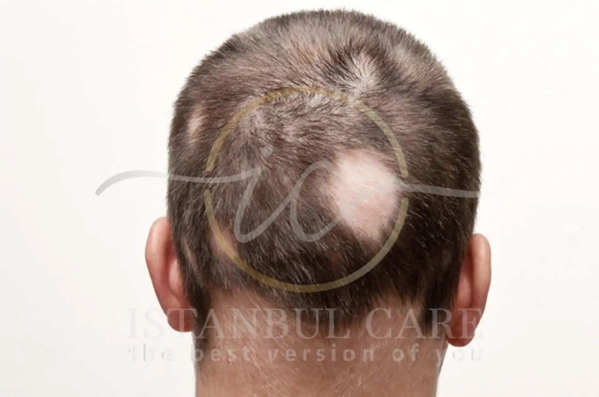 Scarring alopecia causes symptoms and effective treatments