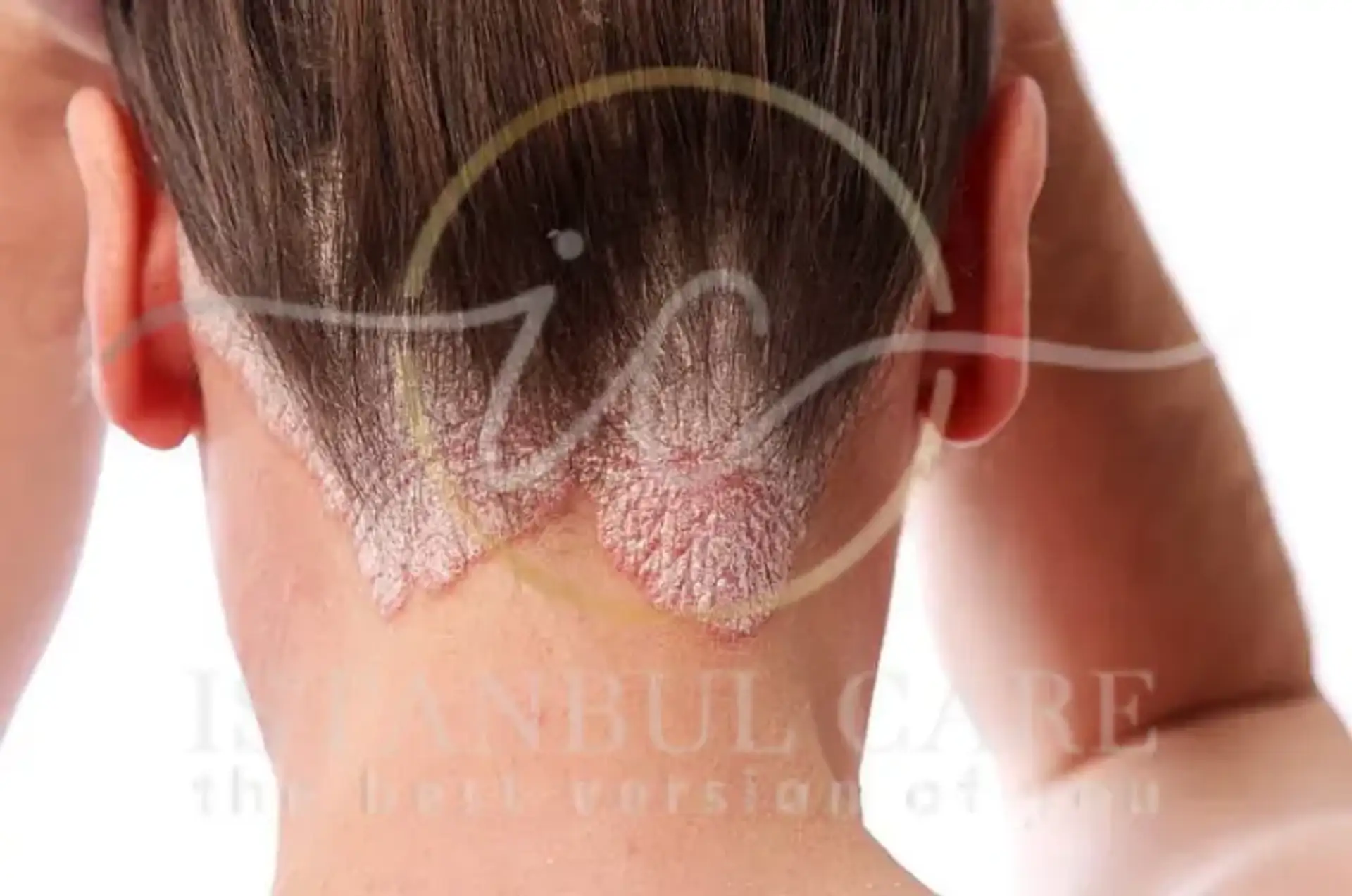 What Is Tinea Capitis – Causes, Symptoms, and Treatment