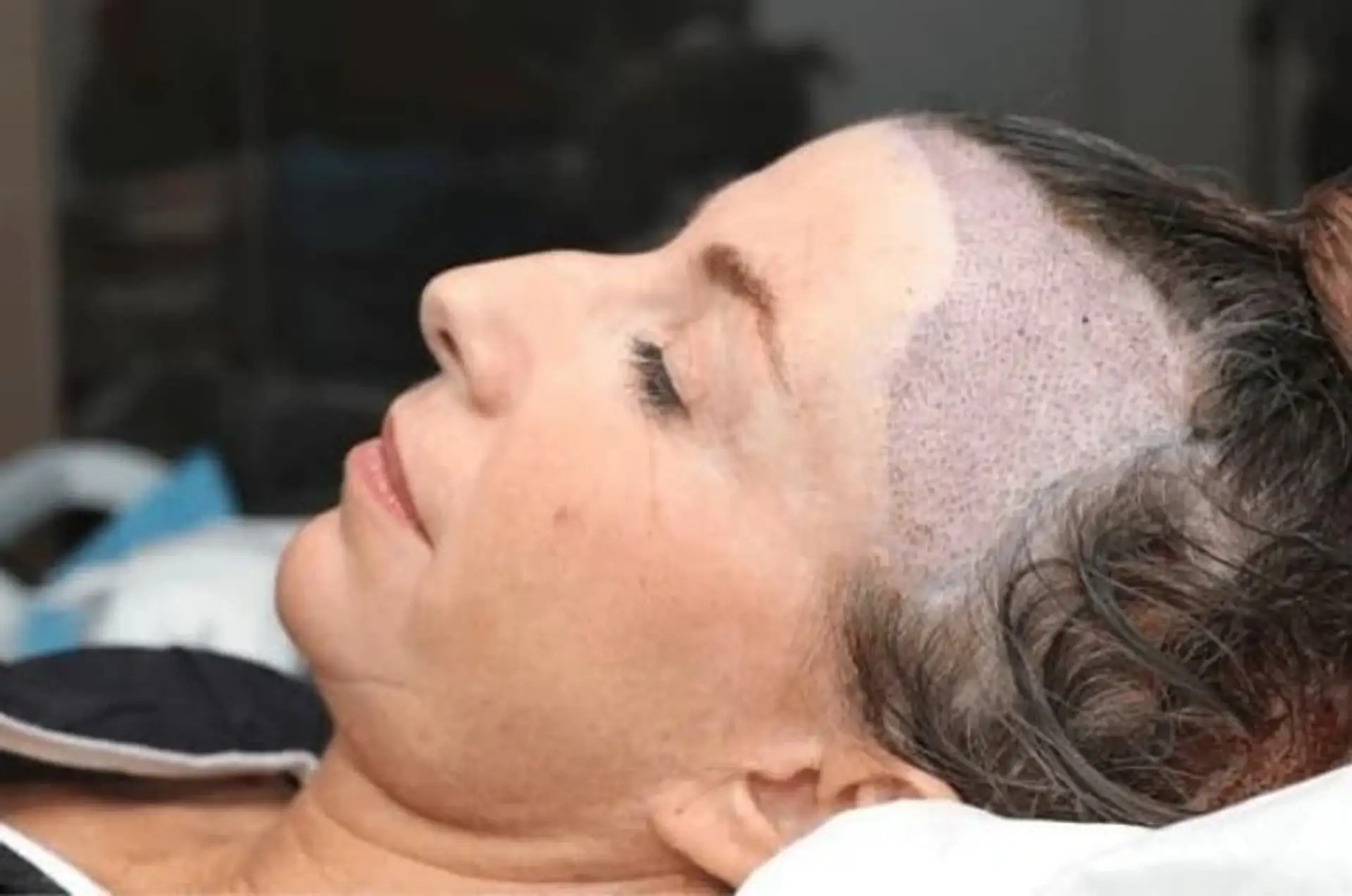 Resultados transplante capilar feminino: cuidados e expectativas