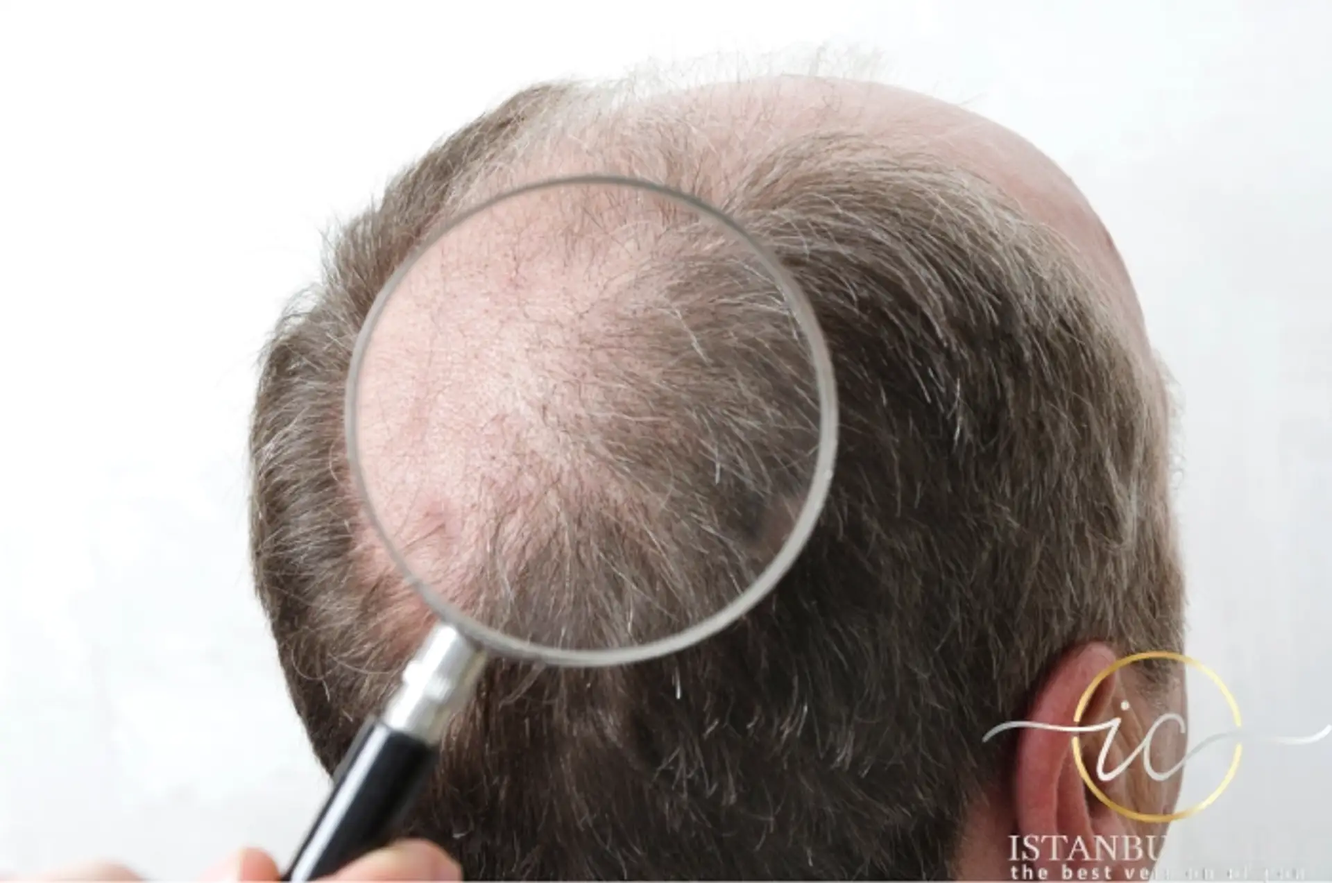 Cause comuni di fallimento del trapianto di capelli
