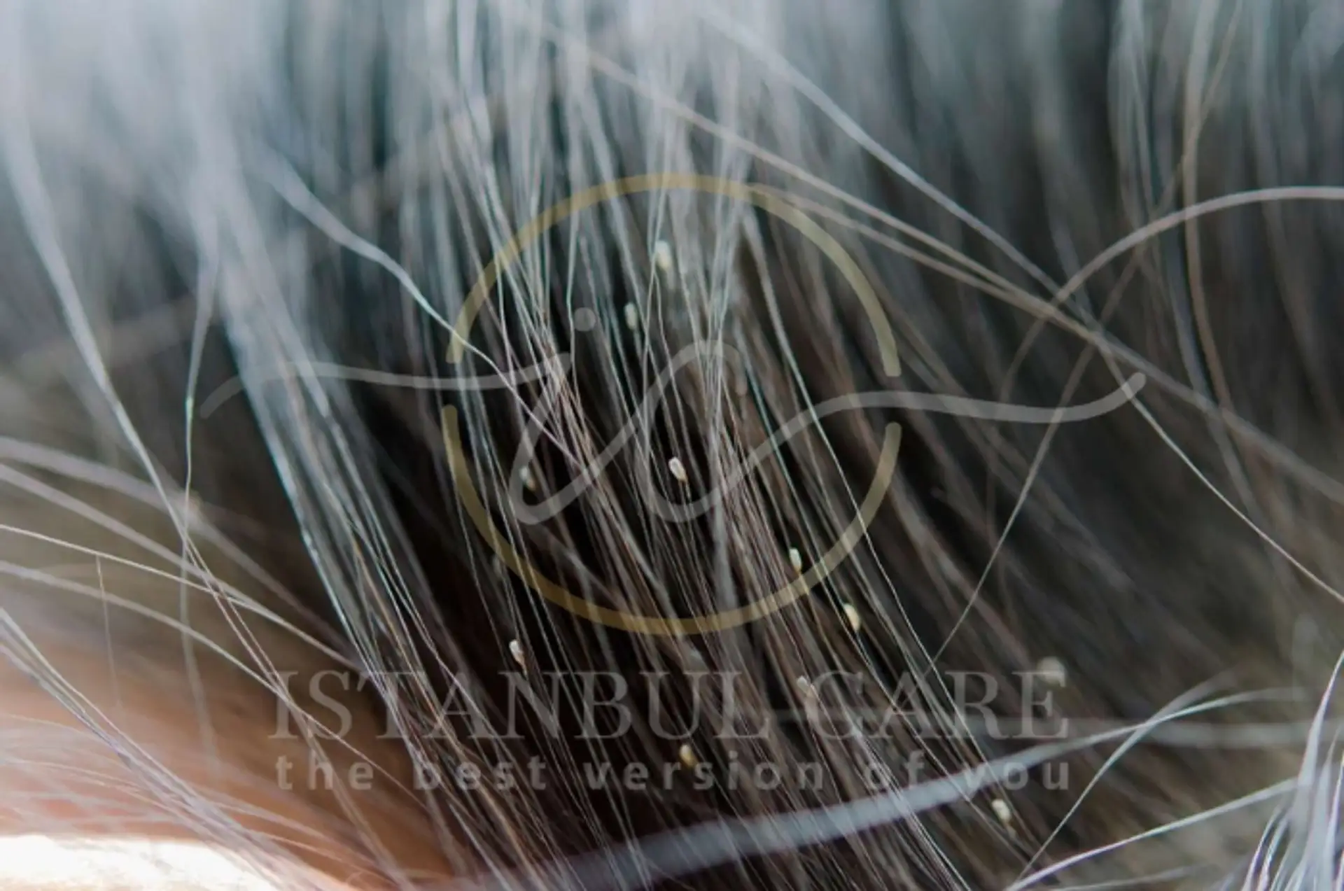 What Head Lice Look Like and How To Treat Them