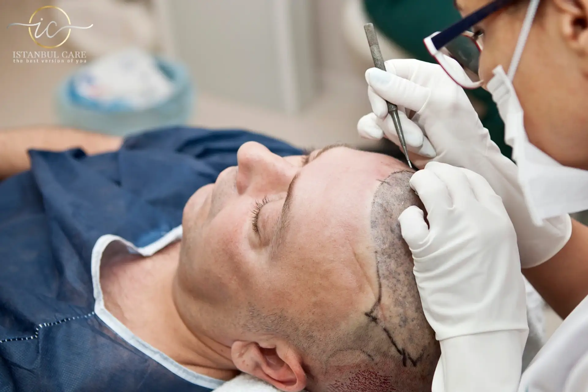 Hair Transplant Maintenance: How to Ensure Long-Lasting Results