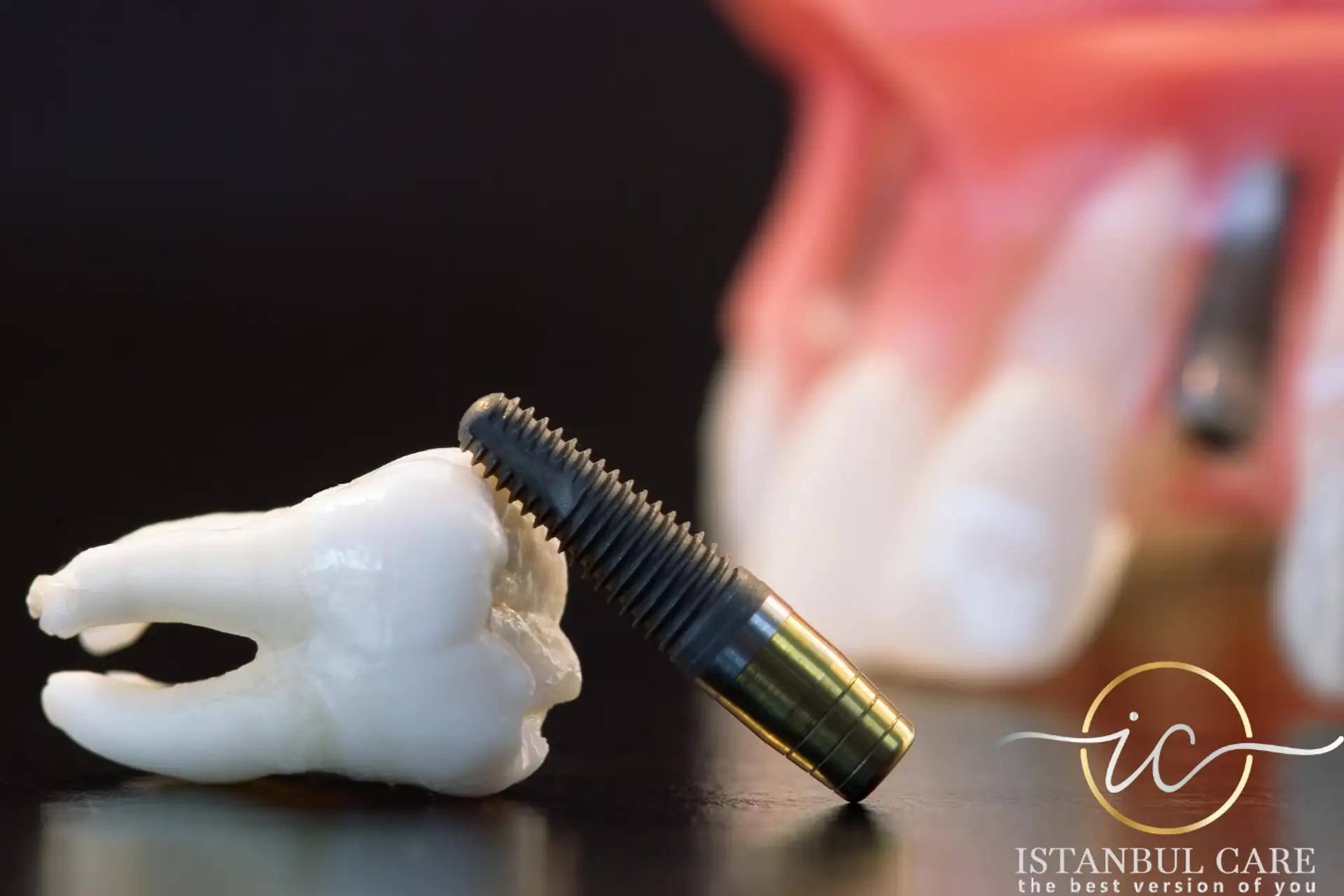 Tratamiento con implantes en Albania: Atención asequible y de calidad