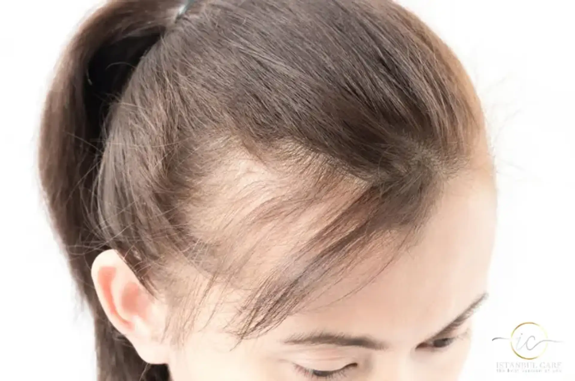 PCOS Hair Loss Causes and Effective Treatment Options to Regrow Hair