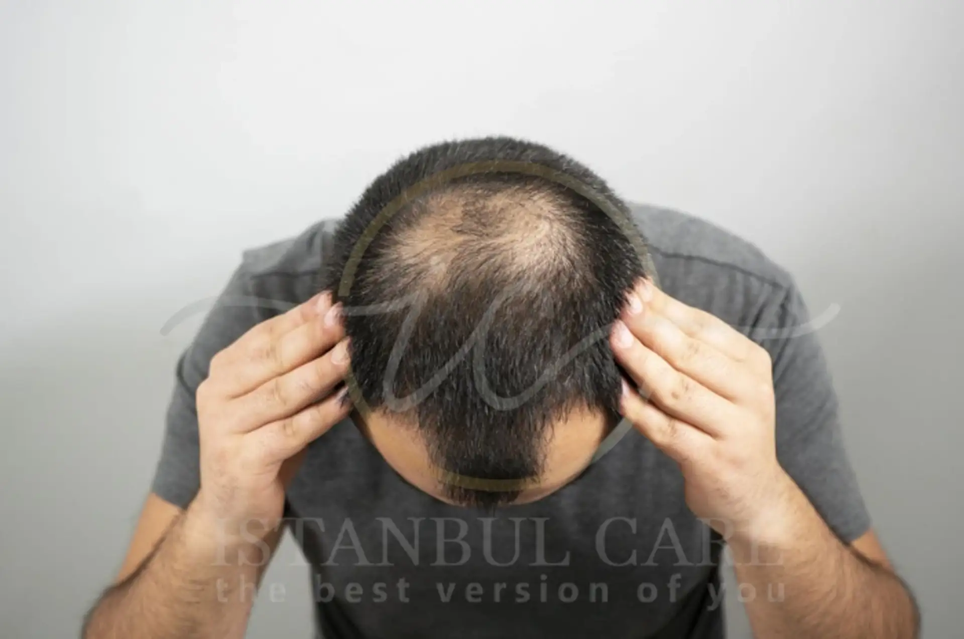 Hair Regrowth for Men Top Products and Solutions