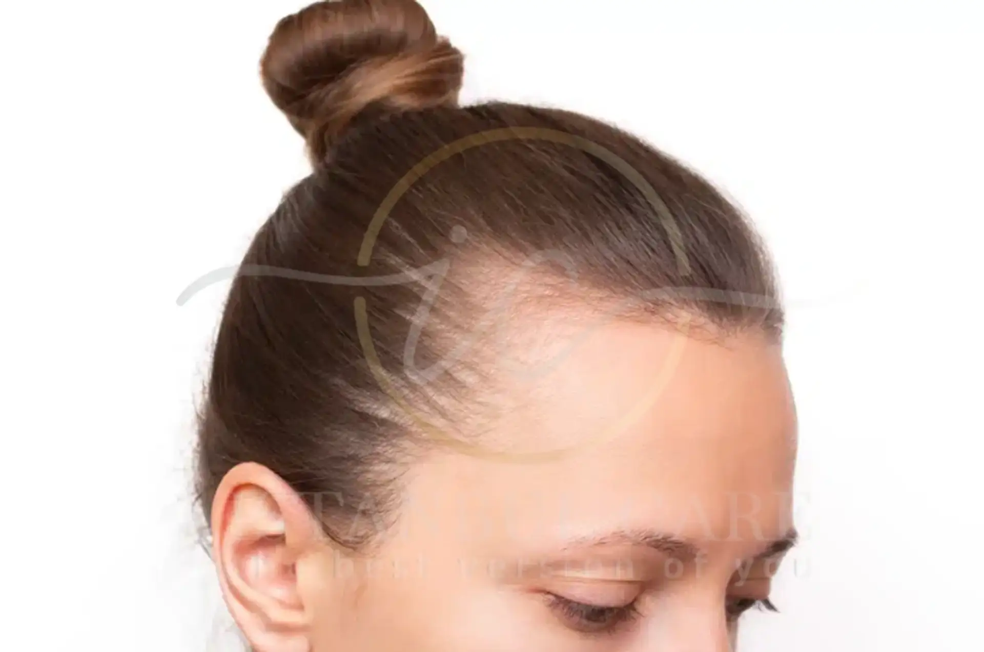Thinning Hair Causes Signs and Treatment Options