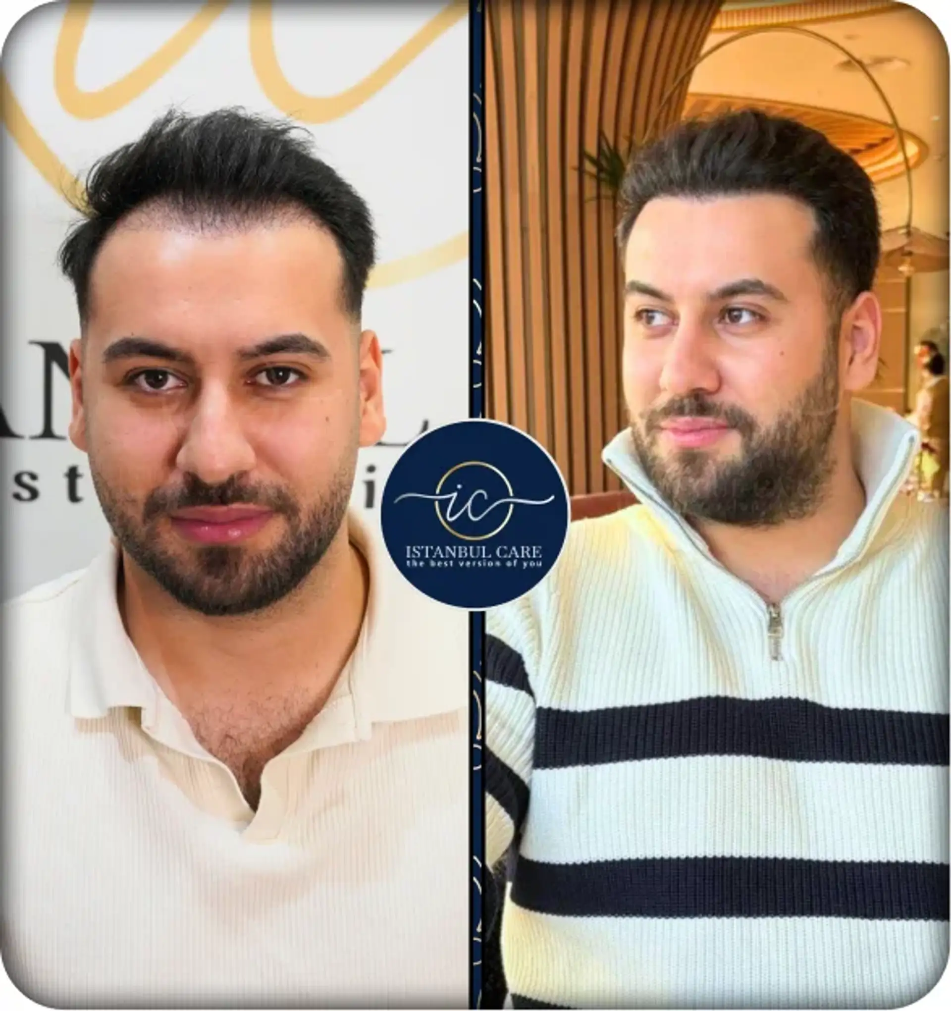 Hair Transplant Before and After