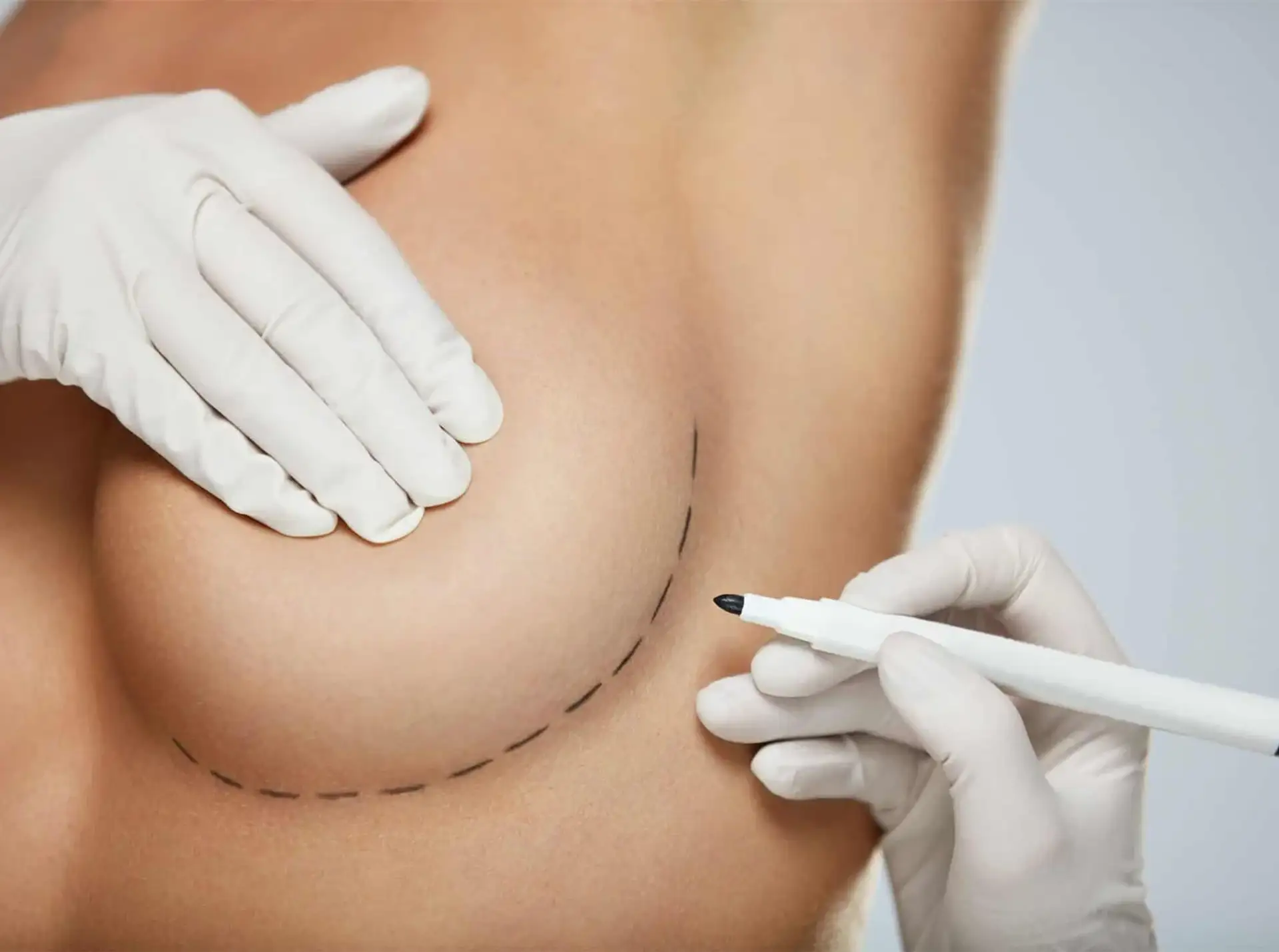 Réduction mammaire par incision verticale