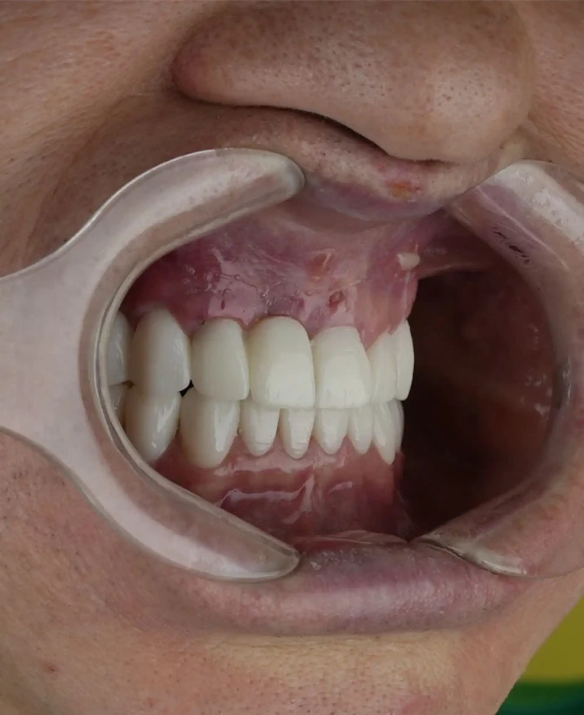 Avantajele și dezavantajele fațetelor dentare E-max