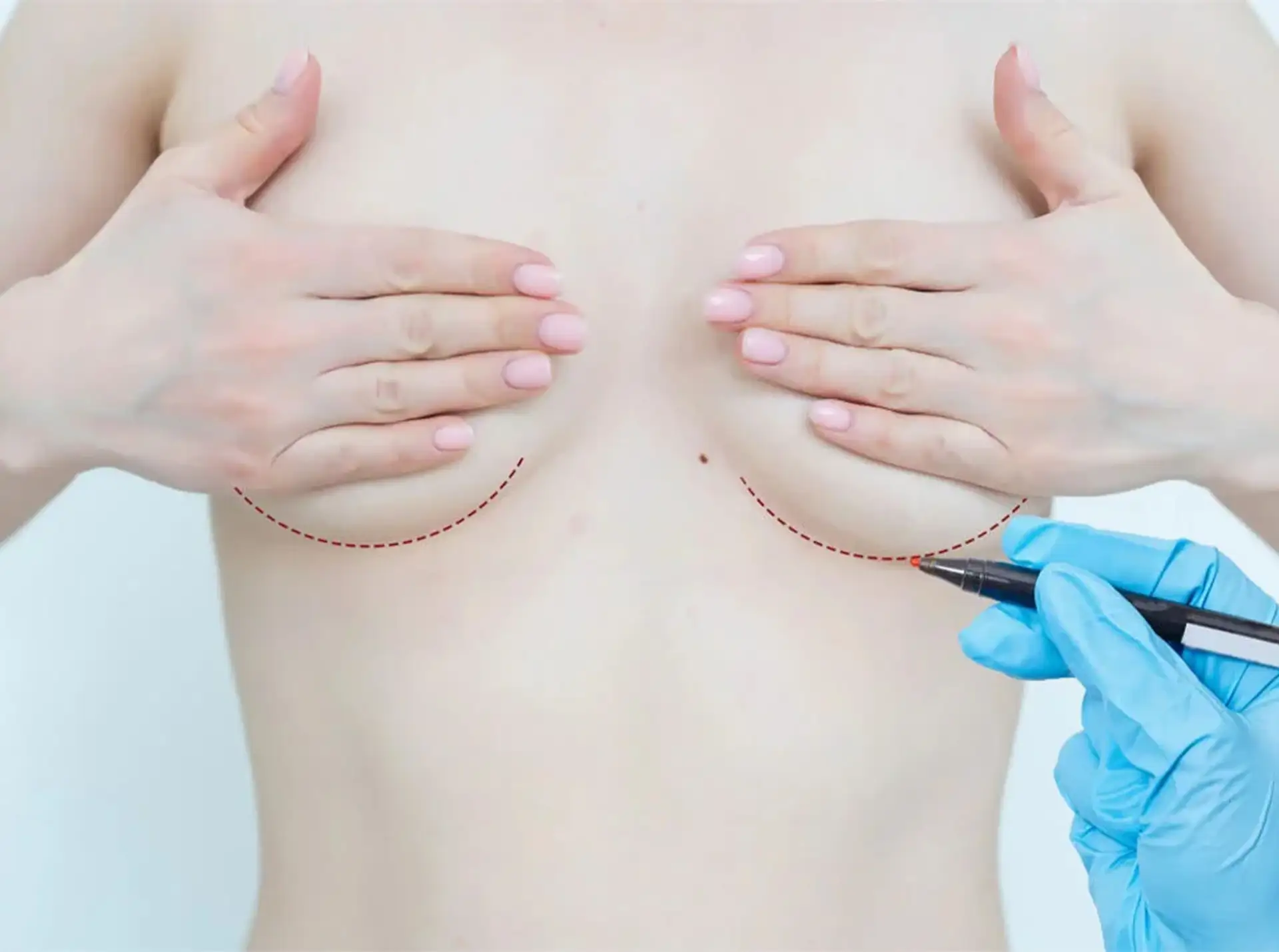Avantages de la chirurgie de réduction mammaire