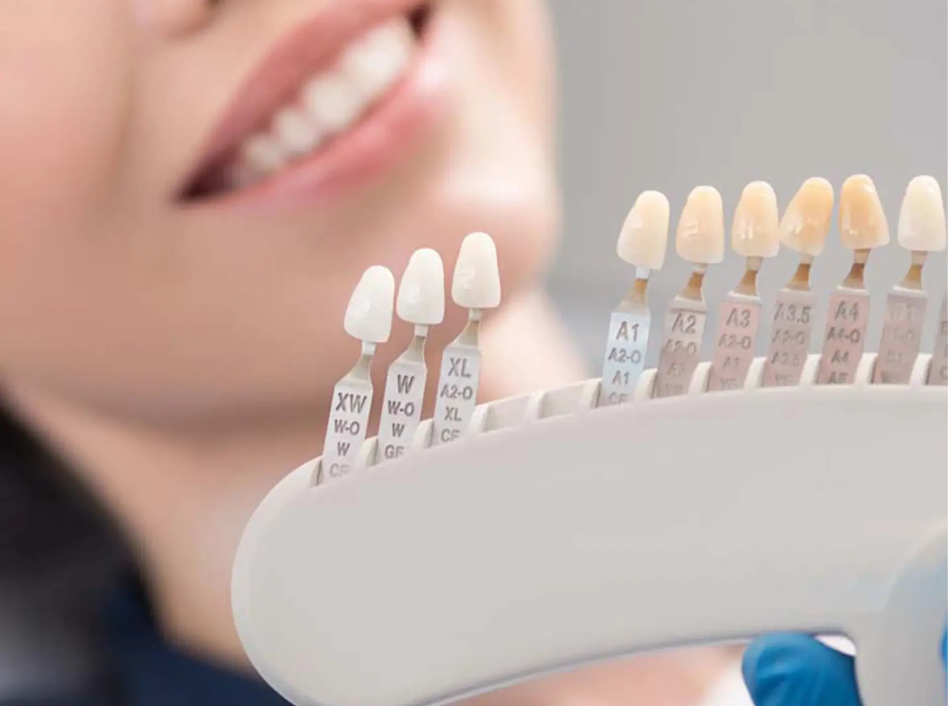 Costul fațetelor dentare E-max în Turcia