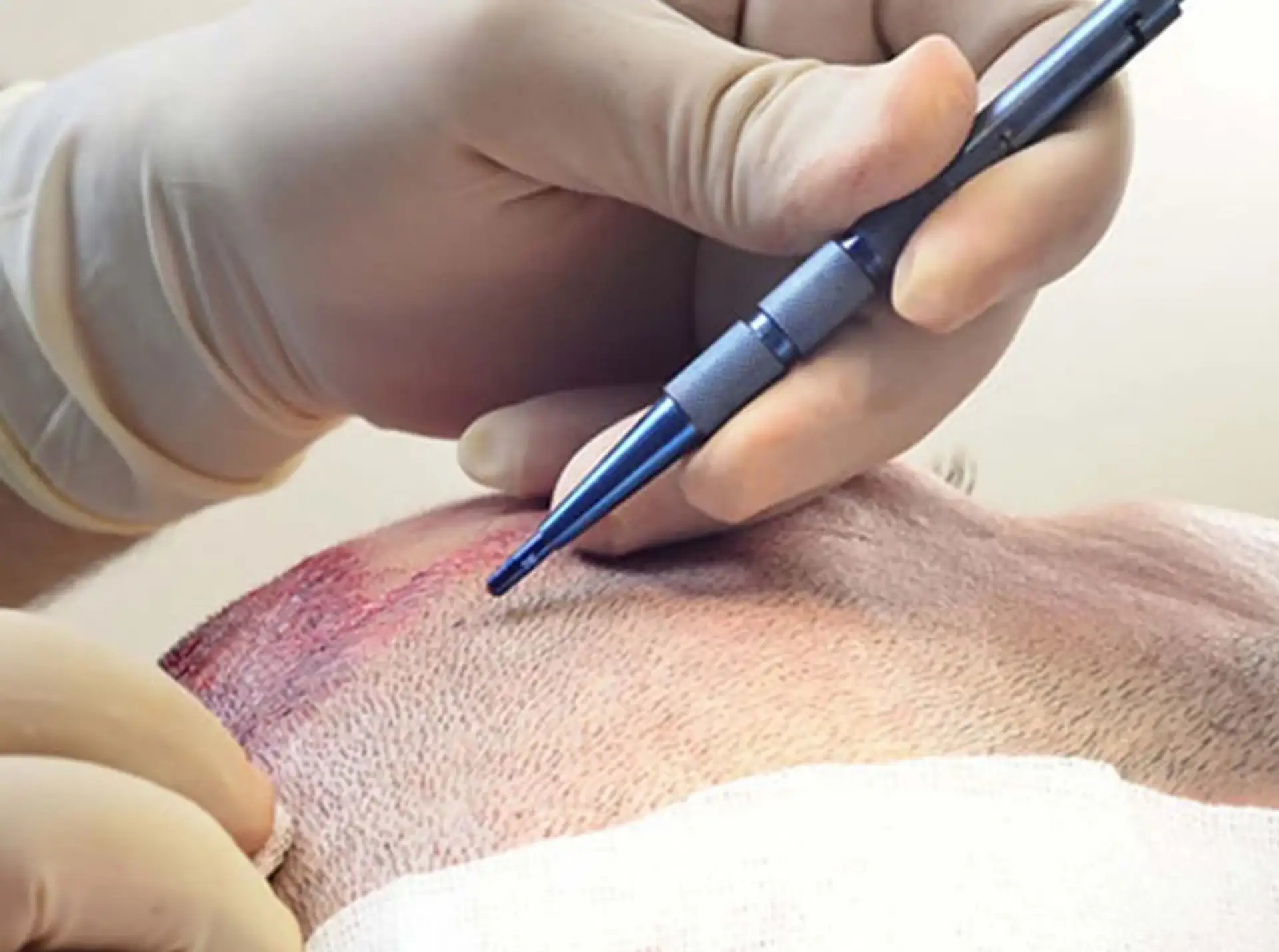 Genießen Sie die Vorteile der Saphir-FUE-Haartransplantation