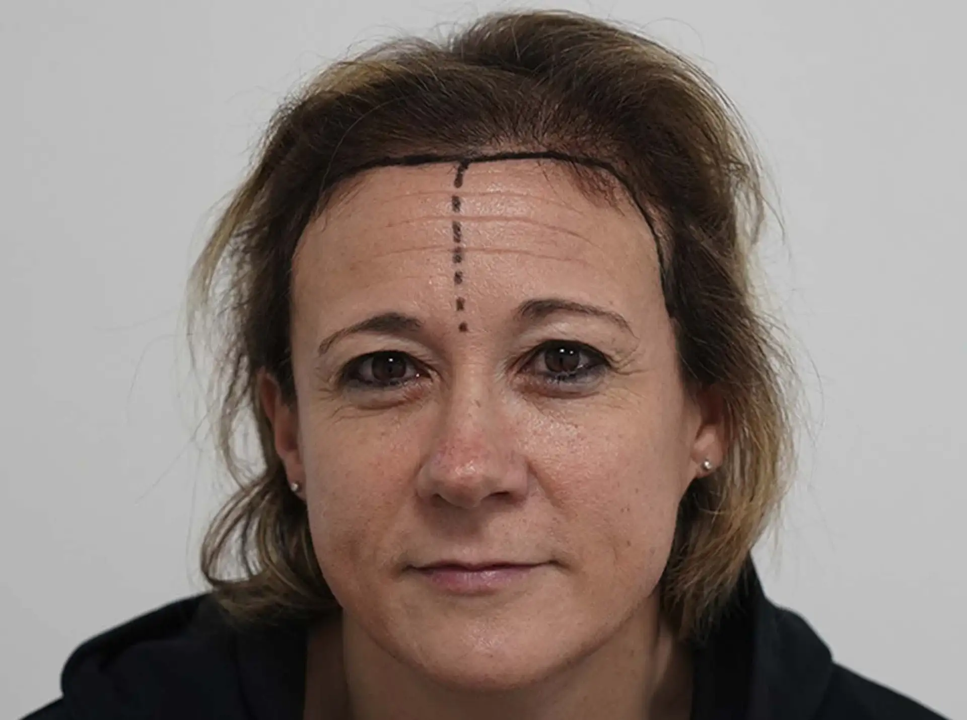 Hair Transplant Methods for Women