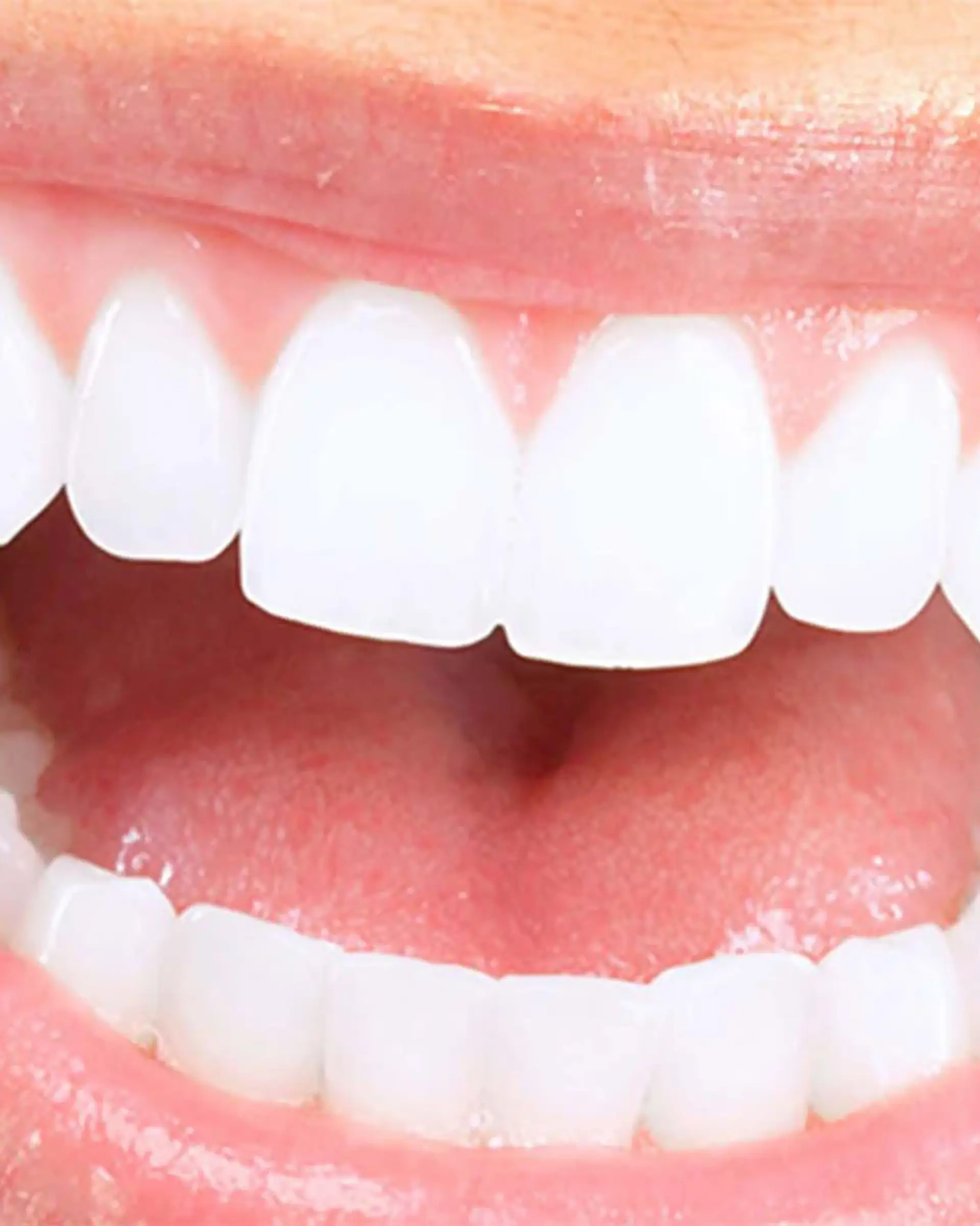 O procedimento de um sorriso hollywoodiano