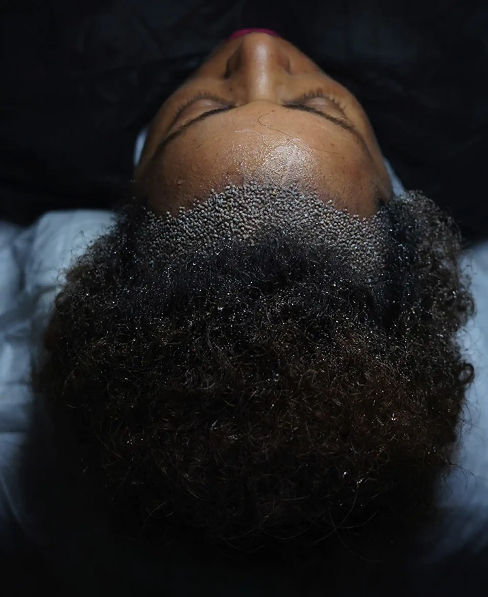 ¿Cuánto tiempo duran los resultados de un trasplante de cabello afro?