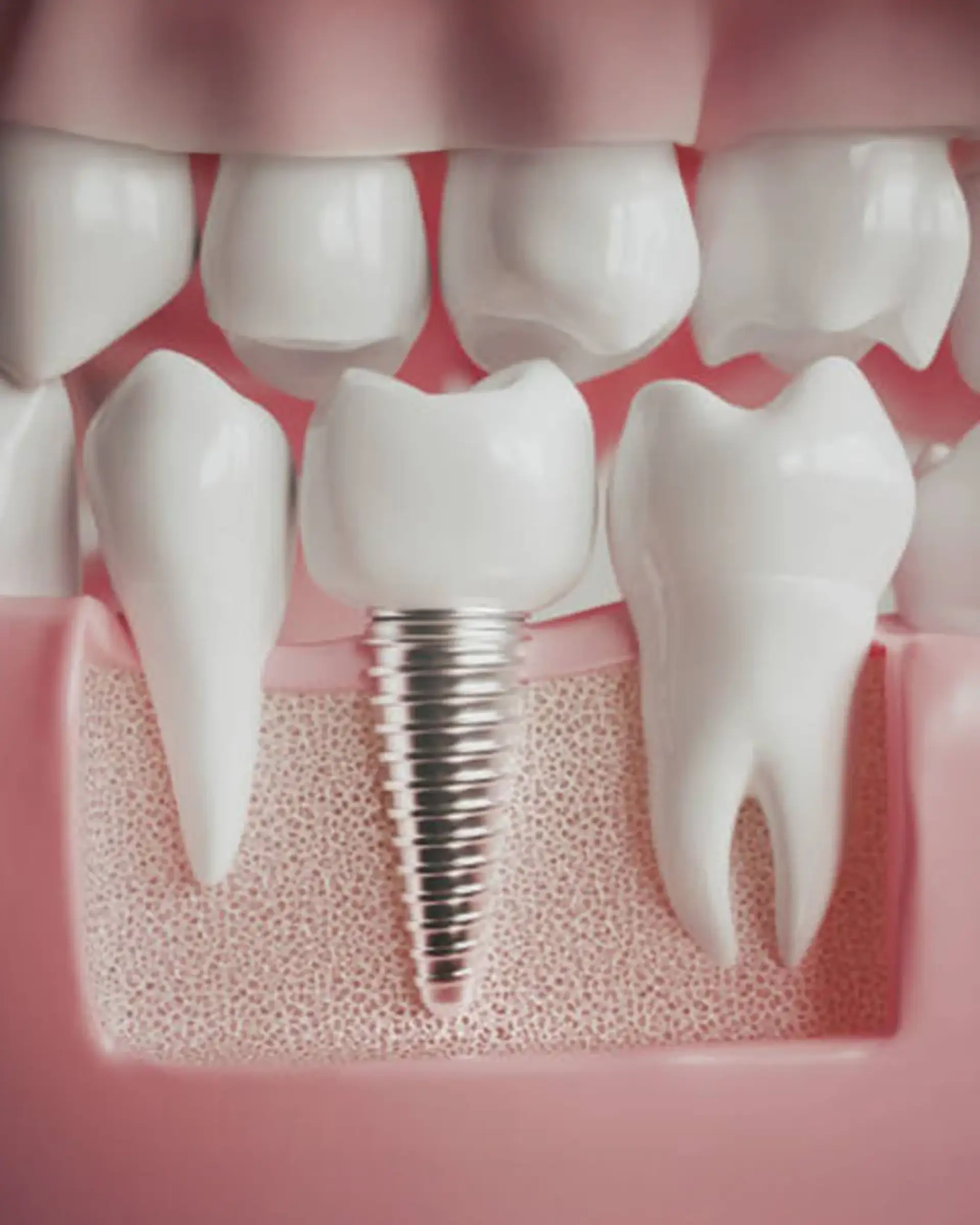 Implant Treatment in Istanbul Care
