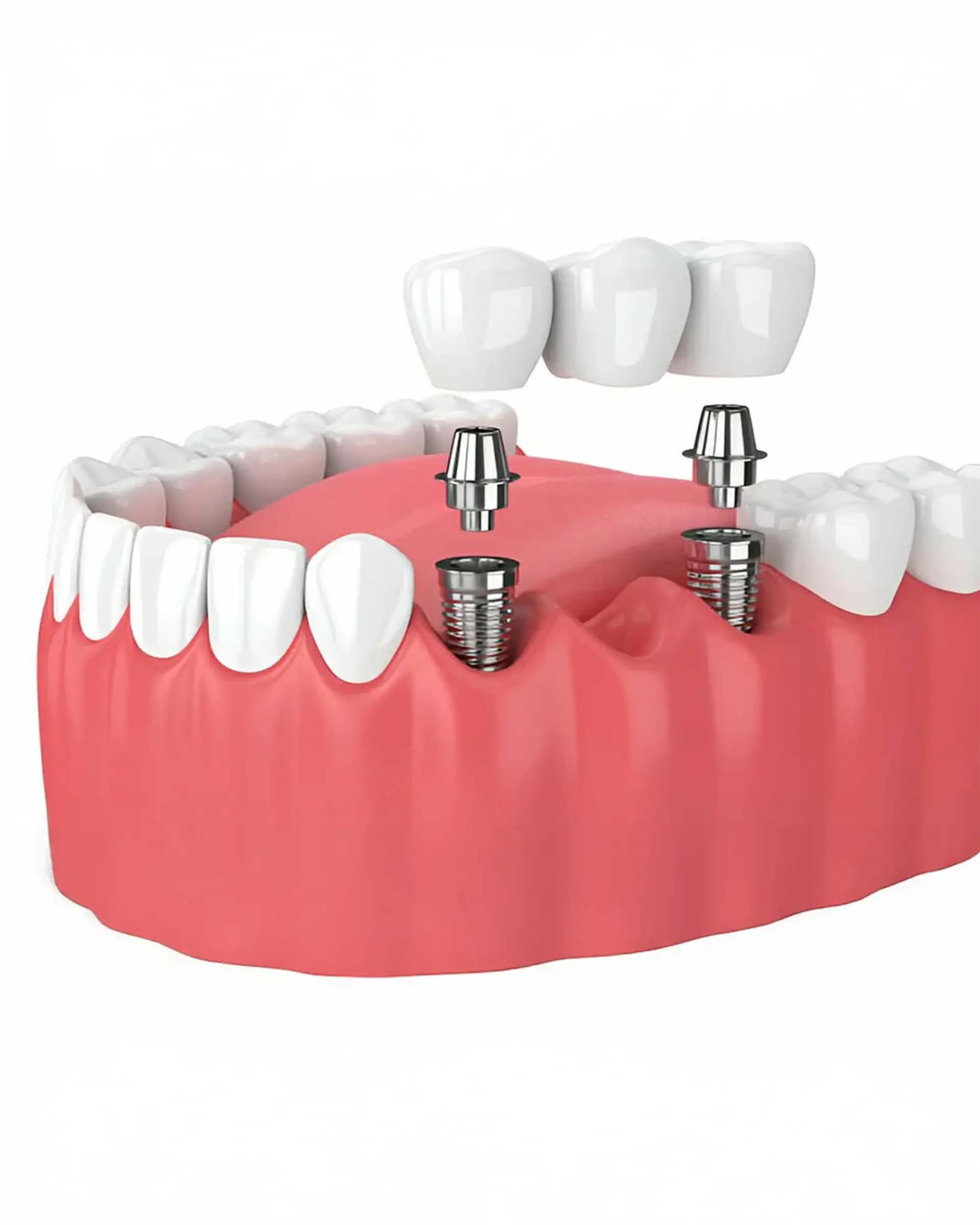 Why Choose Dental Implants Over Traditional Dentures or Bridgework?