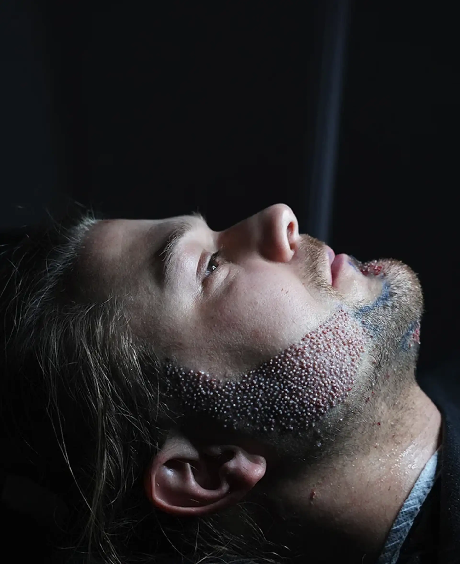 guida per pazienti di trapianto di barba di stile