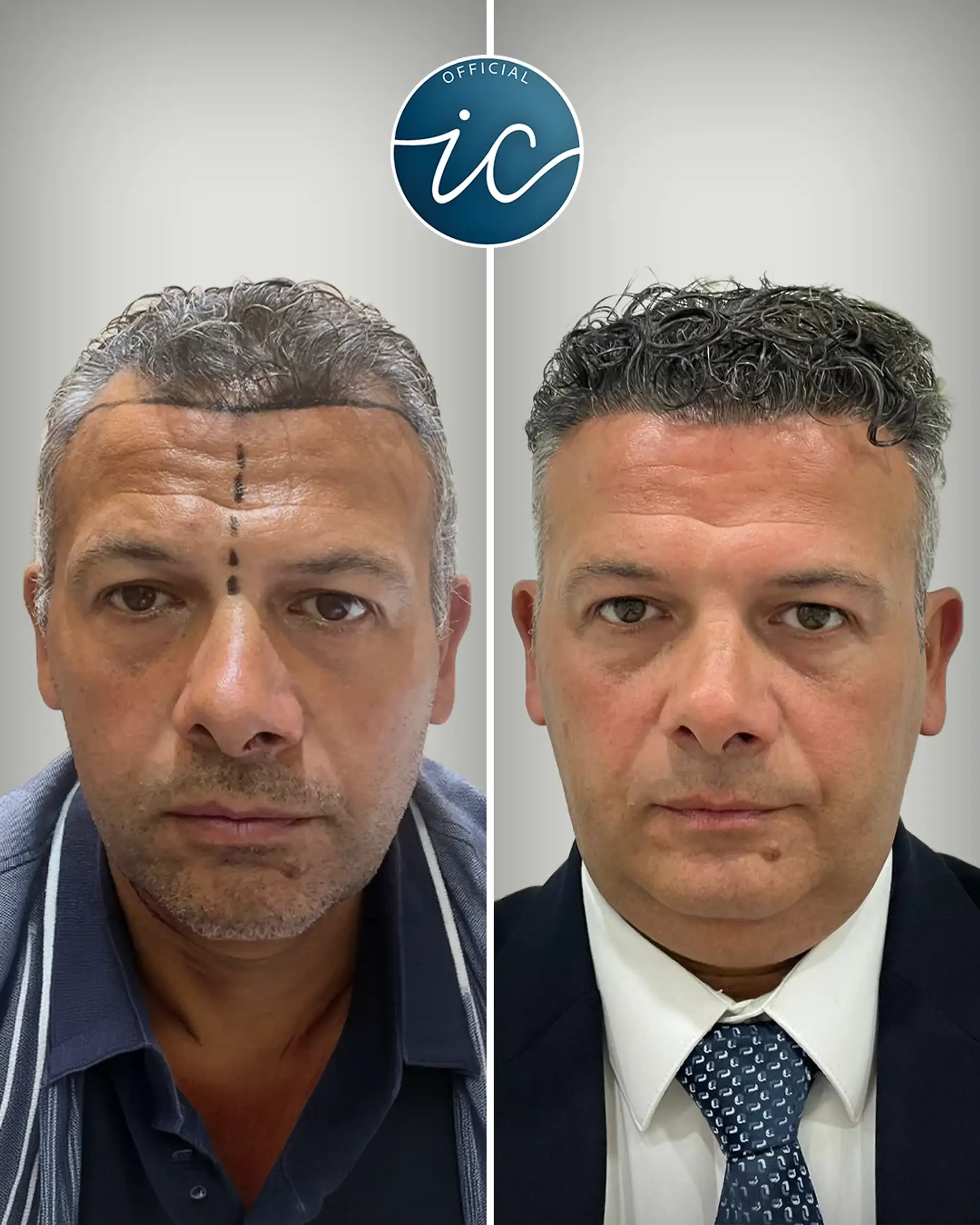 Trapianto di Capelli in Turchia: Tecniche DHI e FUE
