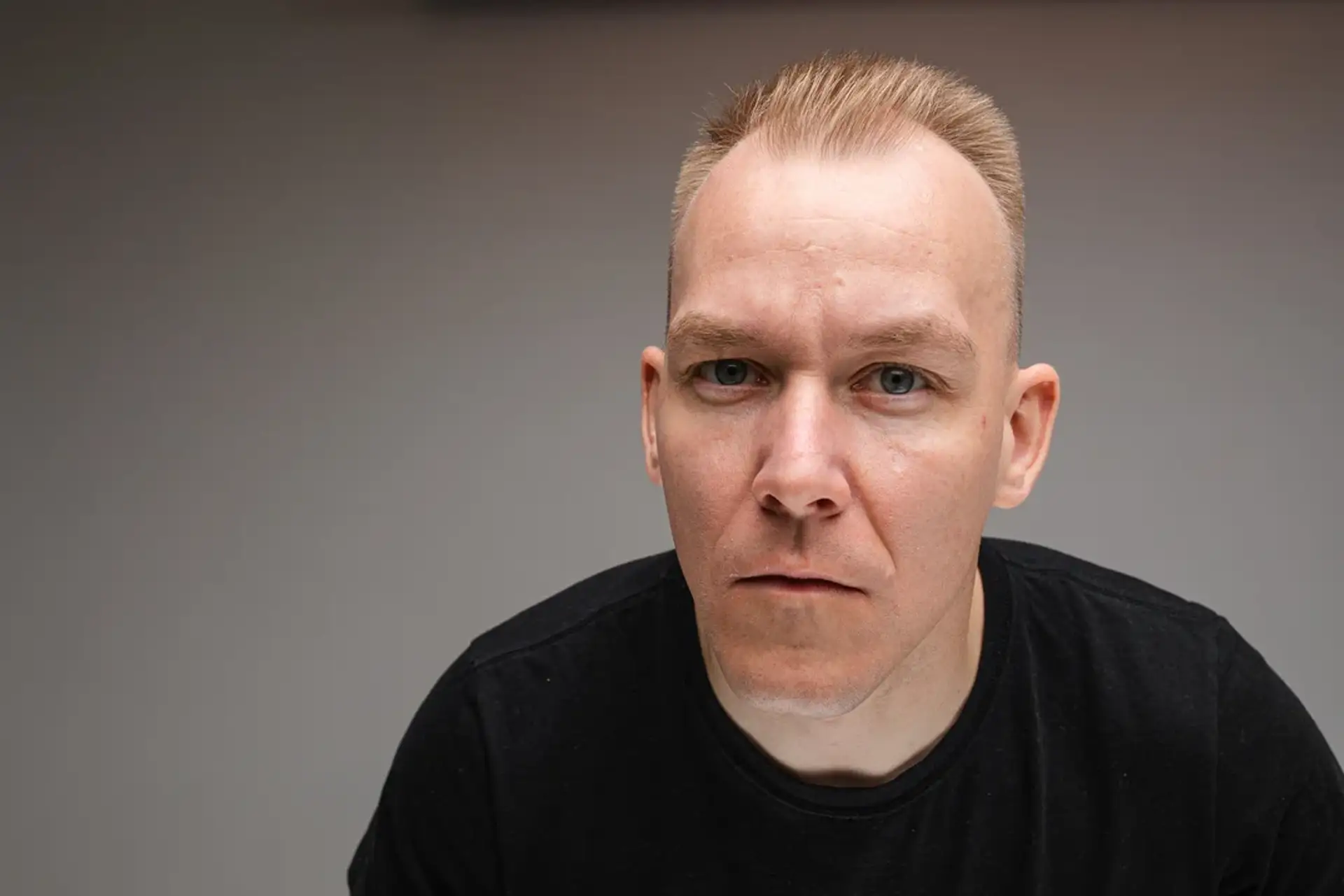 Blonde Hair Transplant in Turkey: Natural Results for Light & Fine Hair