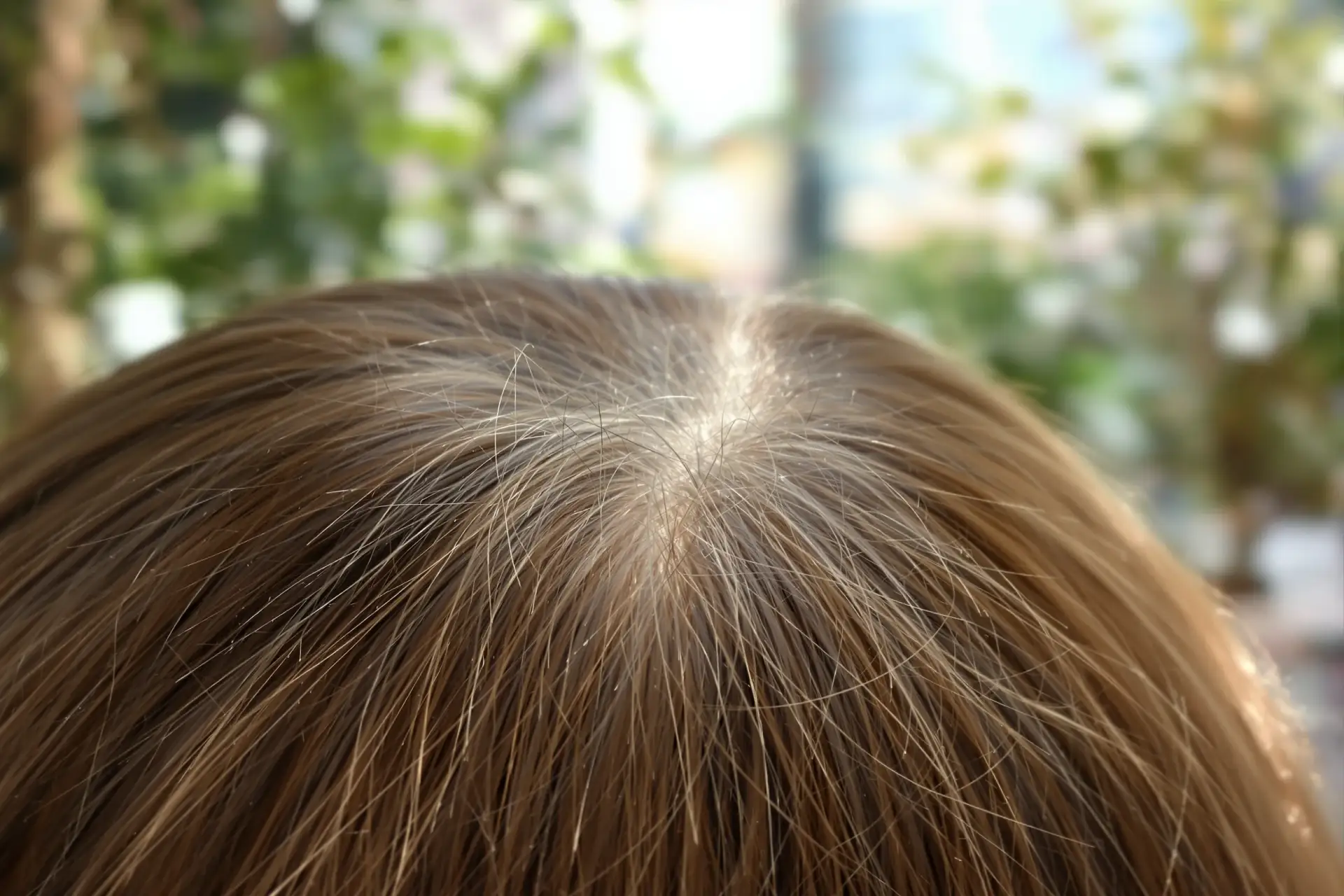 David Beckham Haartransplantation: Was seine Haarlinienveränderung verrät
