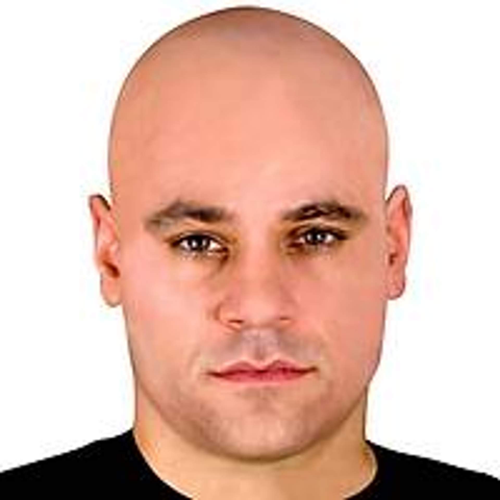 Justin Bieber's Celebrity Hair Transplant: The Facts