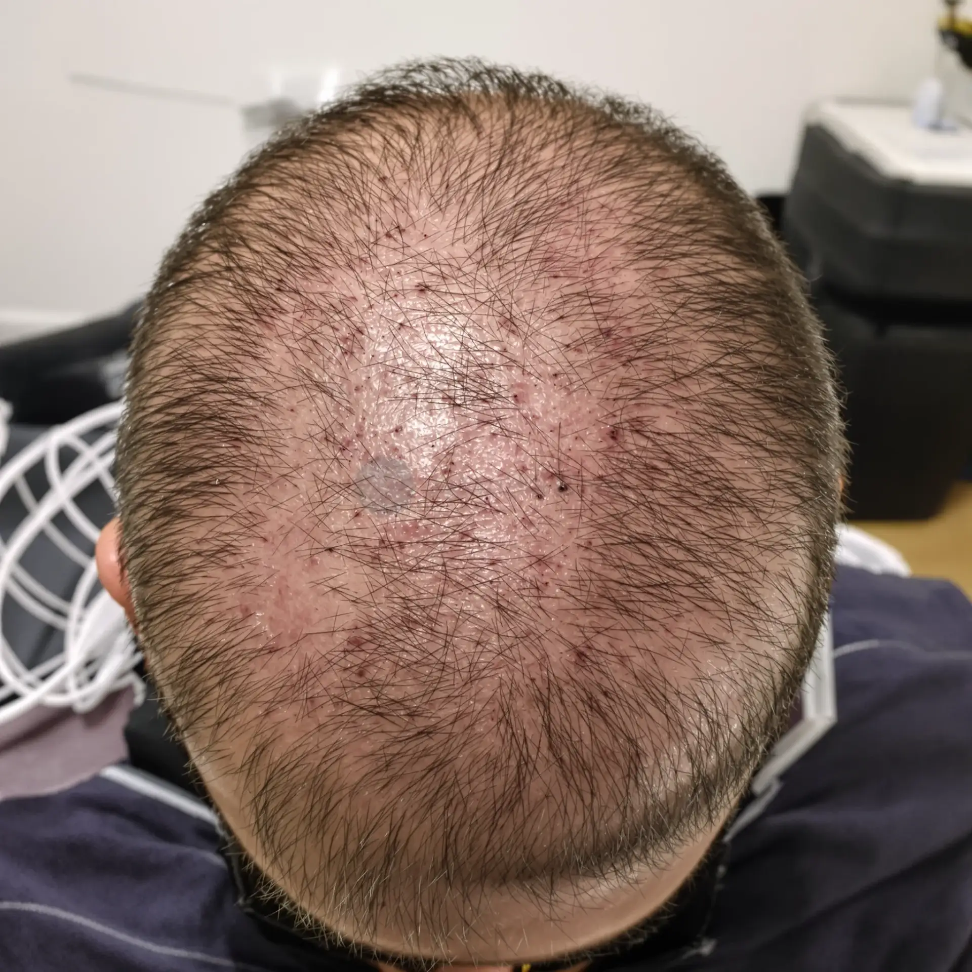 A dhemb transplantimi i flokëve? Raportime nga pacientët