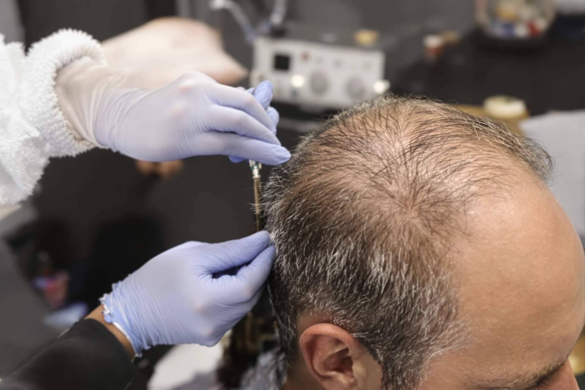 Gloved clinician holding a fine needle over the thinning crown of a seated man during a scalp treatment session.