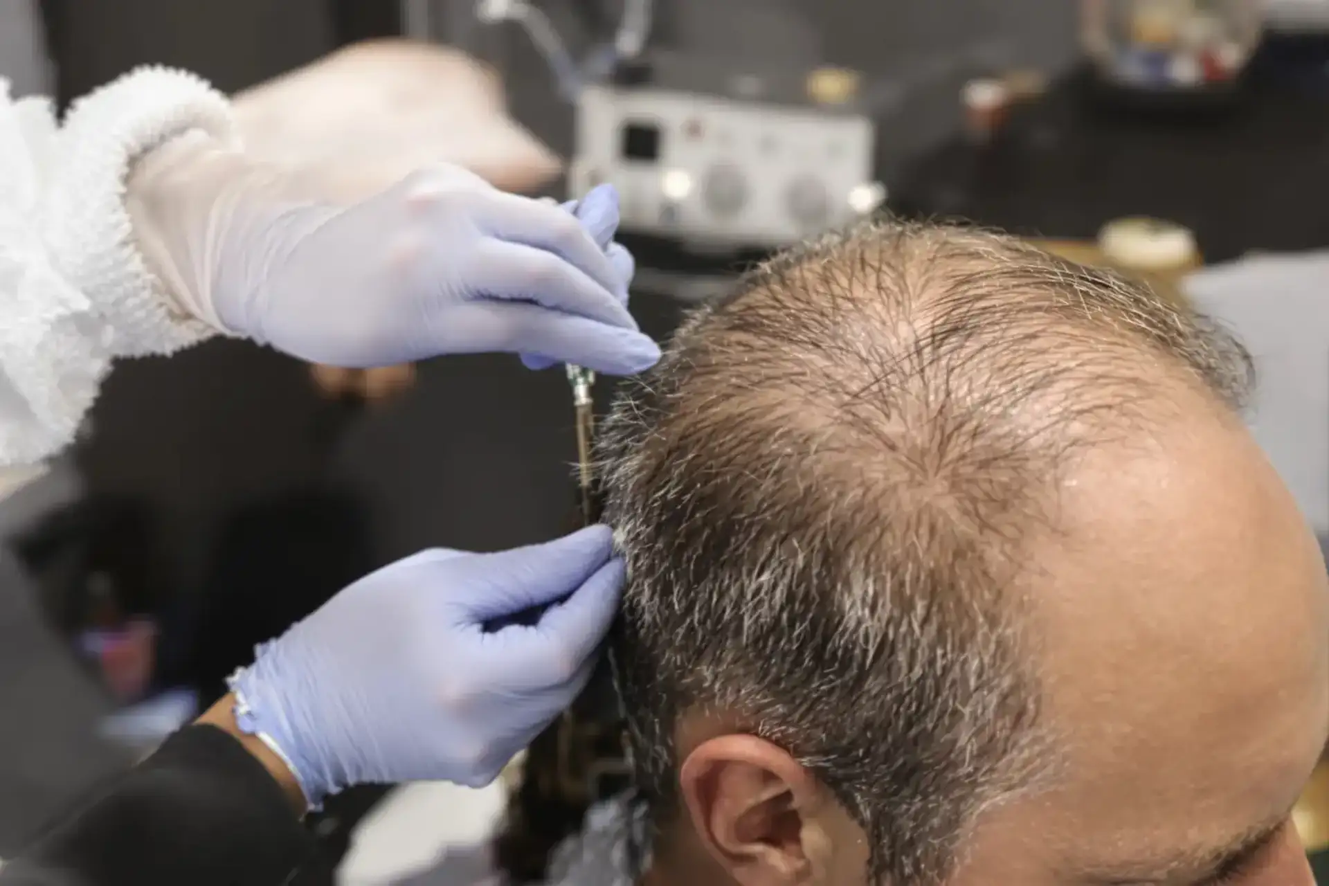 Gloved clinician holding a fine needle over the thinning crown of a seated man during a scalp treatment session.