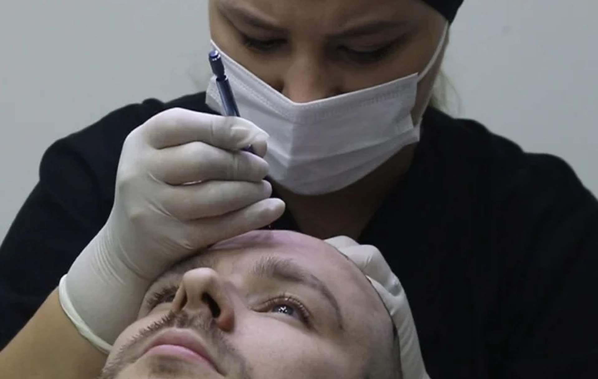 Paulo Costa Hair Transplant — Costs & Hidden Fees Explained